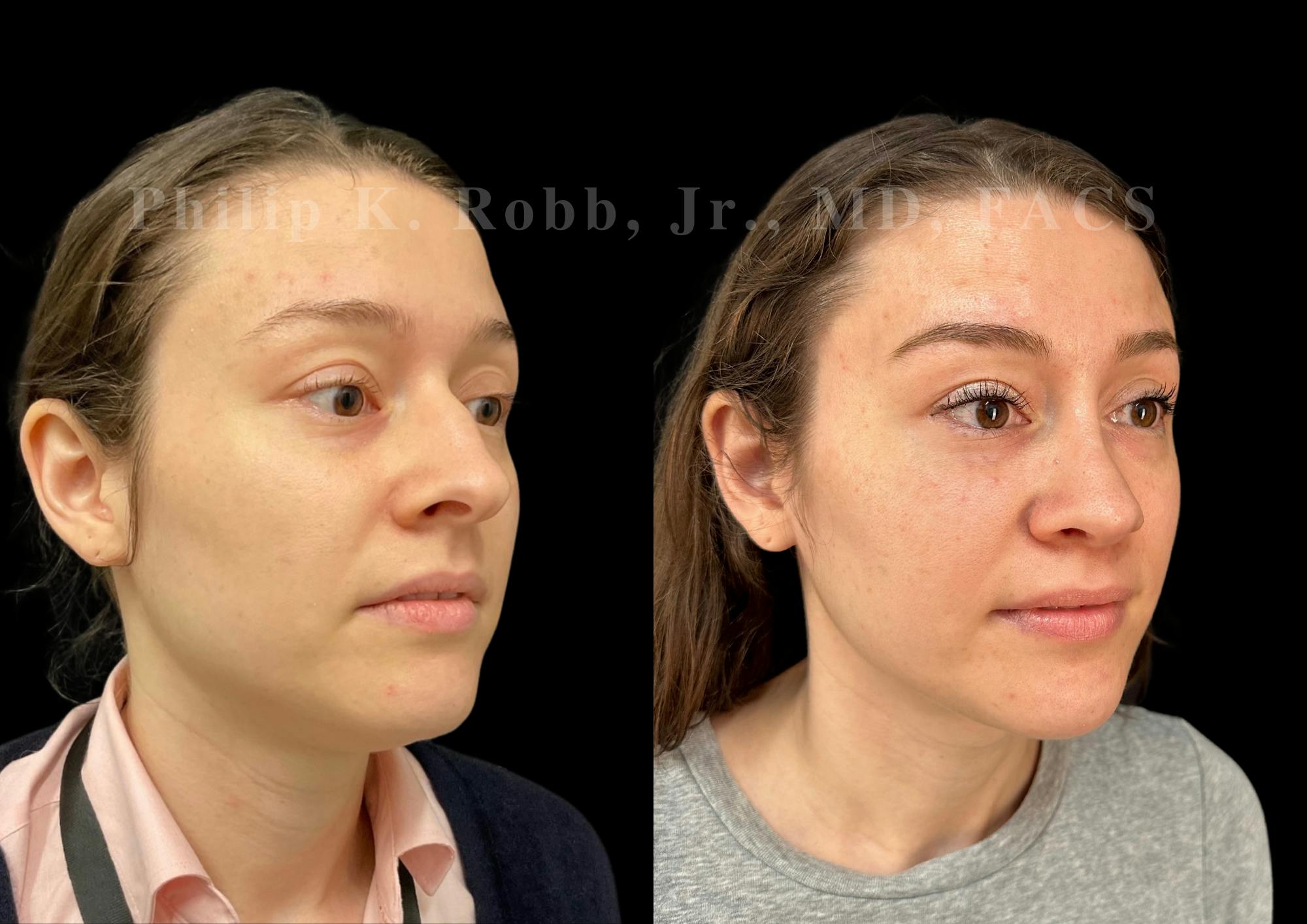 Ultrasonic Rhinoplasty Before & After Gallery - Patient 313385 - Image 2