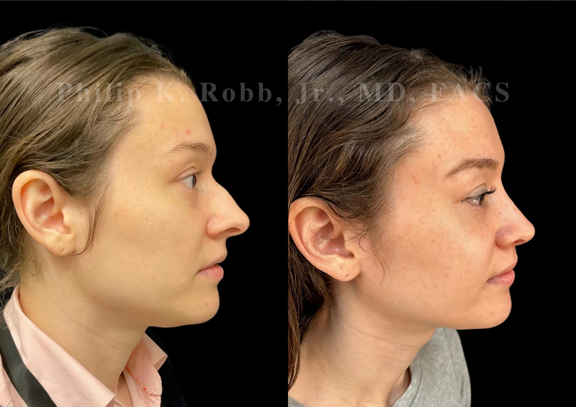 Ultrasonic Rhinoplasty Before & After Gallery - Patient 313385 - Image 1
