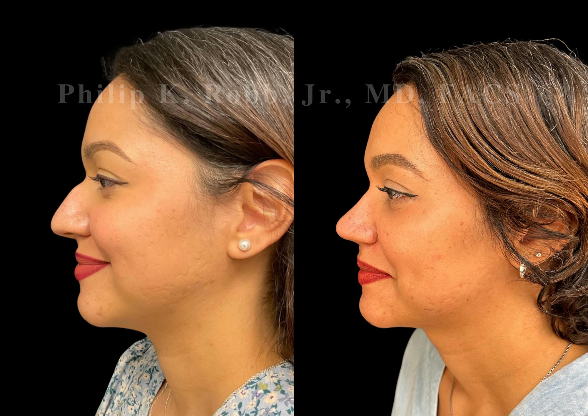 Ultrasonic Rhinoplasty Before & After Gallery - Patient 993923 - Image 5
