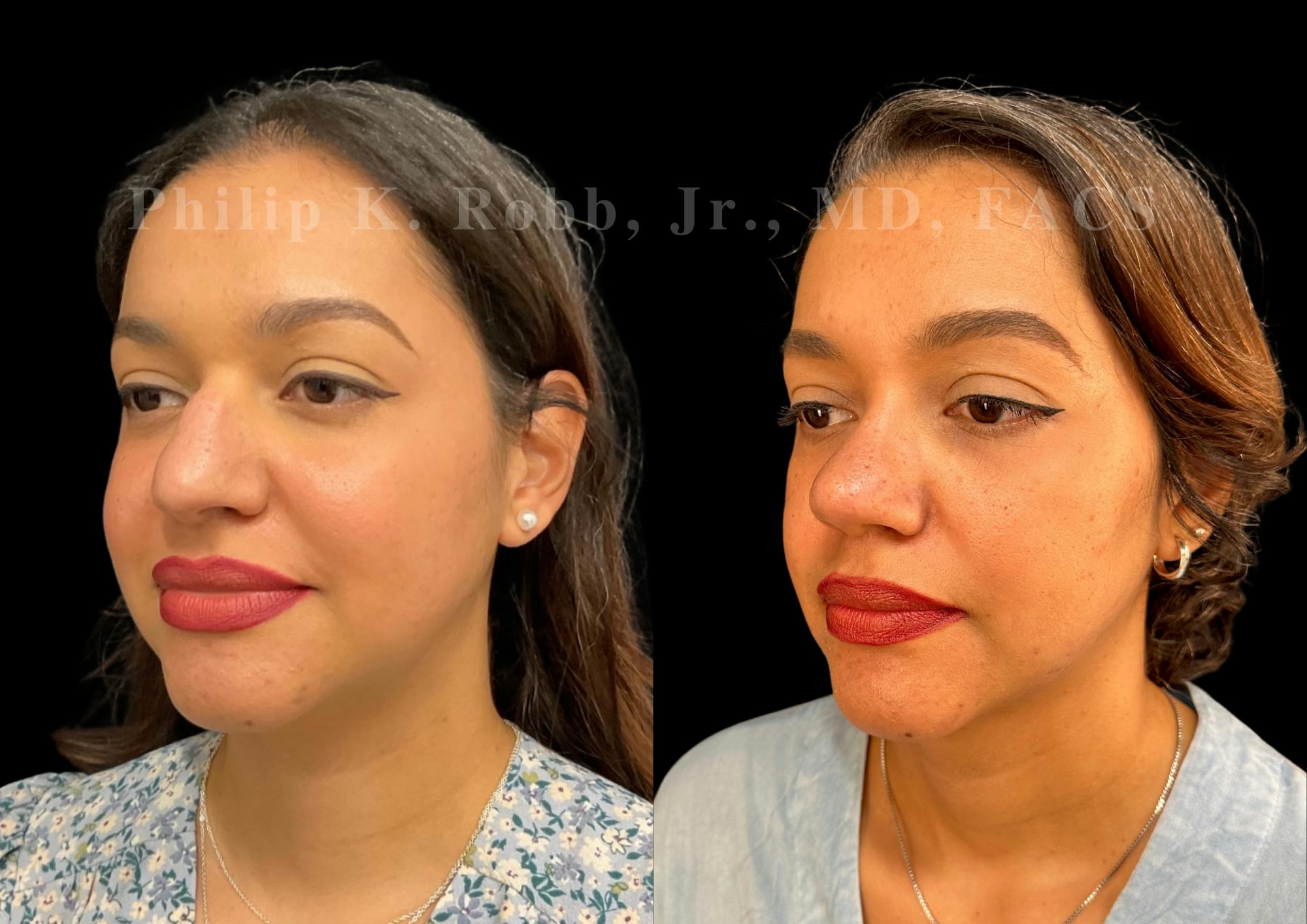 Ultrasonic Rhinoplasty Before & After Gallery - Patient 993923 - Image 4