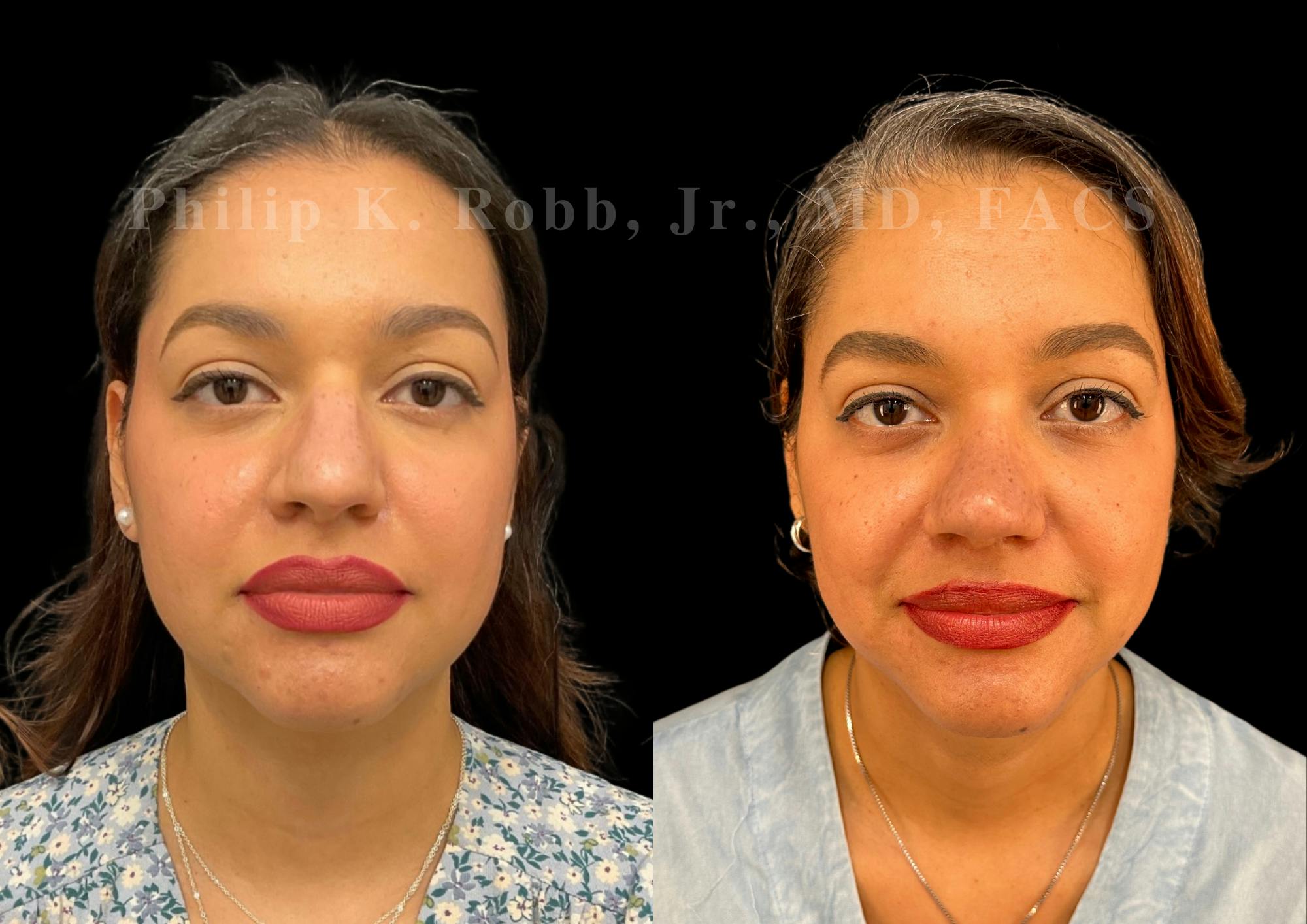Ultrasonic Rhinoplasty Before & After Gallery - Patient 993923 - Image 3