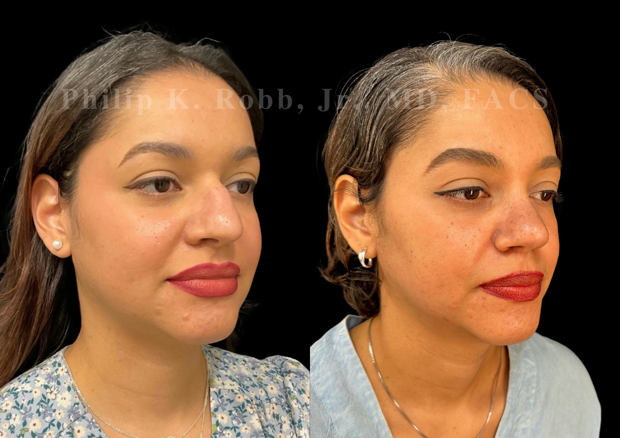 Ultrasonic Rhinoplasty Before & After Gallery - Patient 993923 - Image 2