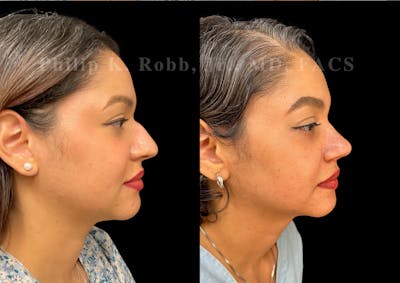 Ultrasonic Rhinoplasty Before & After Gallery - Patient 993923 - Image 1