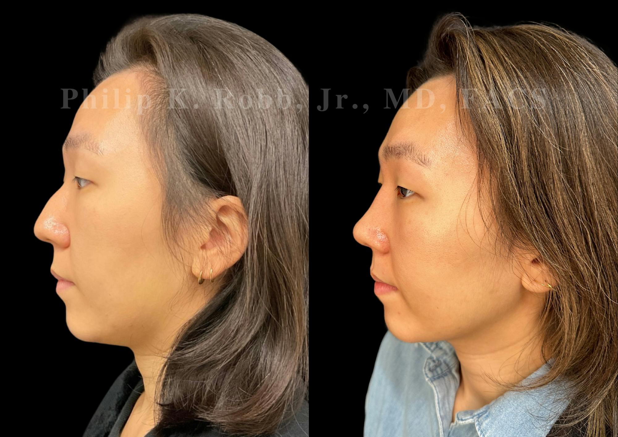 Ultrasonic Rhinoplasty Before & After Gallery - Patient 287108 - Image 5