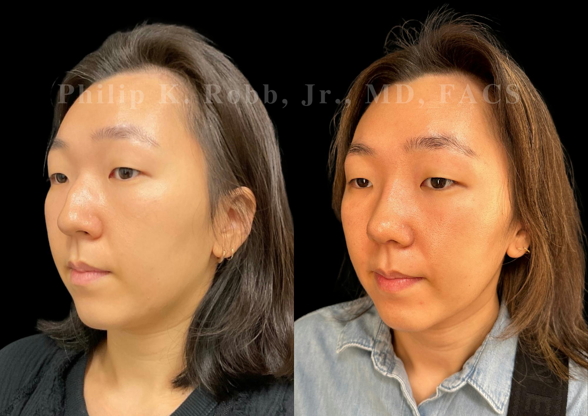 Ultrasonic Rhinoplasty Before & After Gallery - Patient 287108 - Image 4
