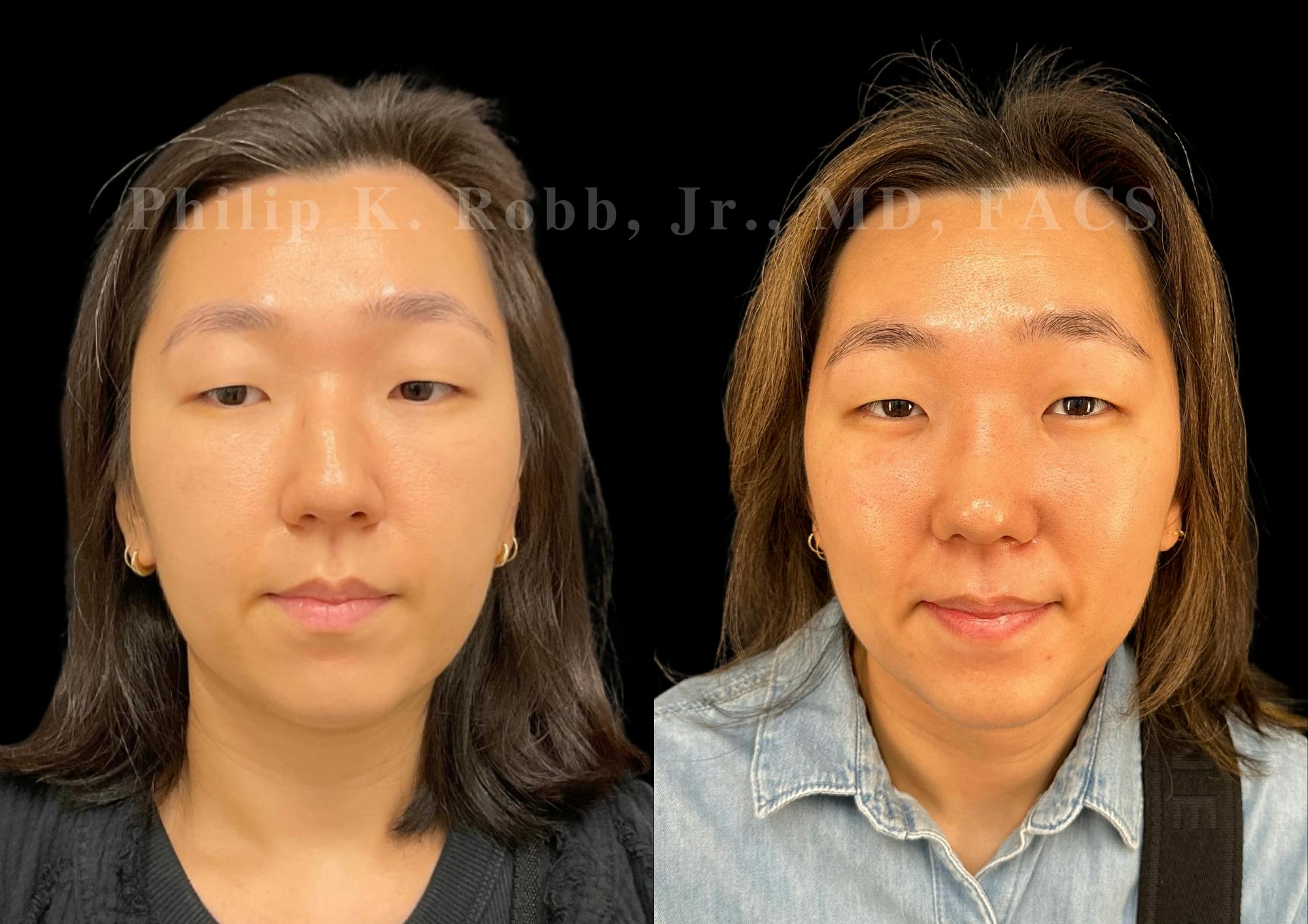 Ultrasonic Rhinoplasty Before & After Gallery - Patient 287108 - Image 3