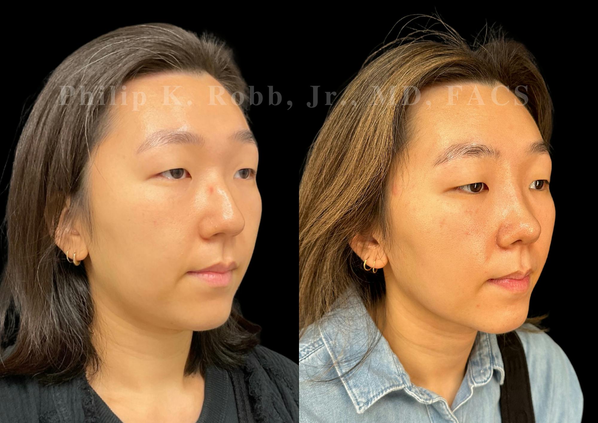 Ultrasonic Rhinoplasty Before & After Gallery - Patient 287108 - Image 2
