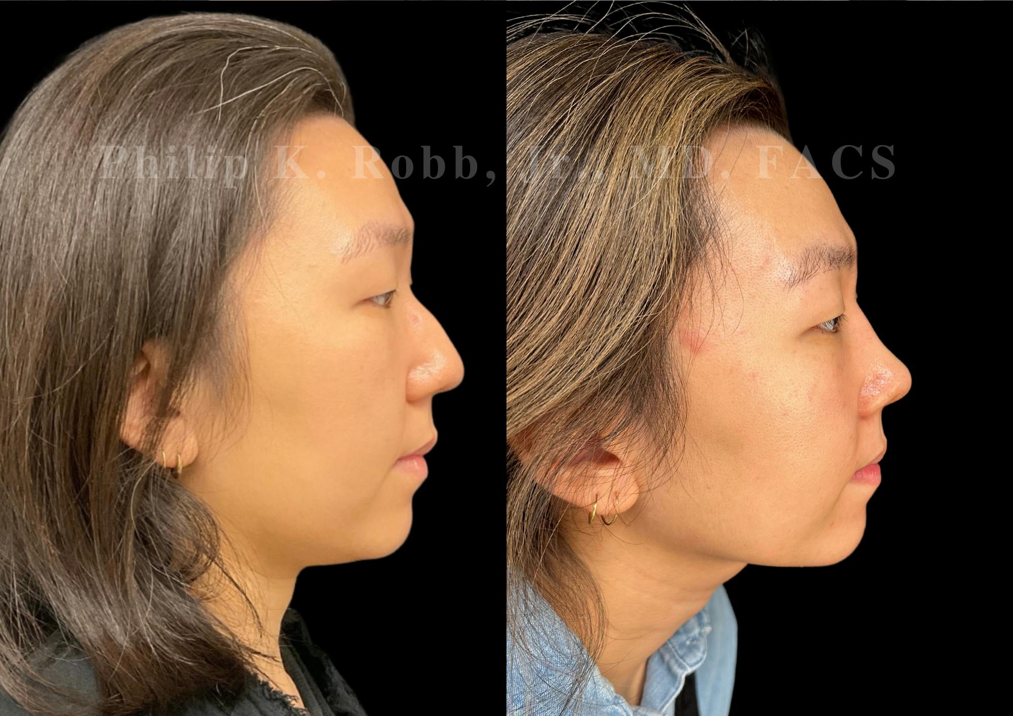 Ultrasonic Rhinoplasty Before & After Gallery - Patient 287108 - Image 1