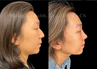 Ultrasonic Rhinoplasty Before & After Gallery - Patient 287108 - Image 1