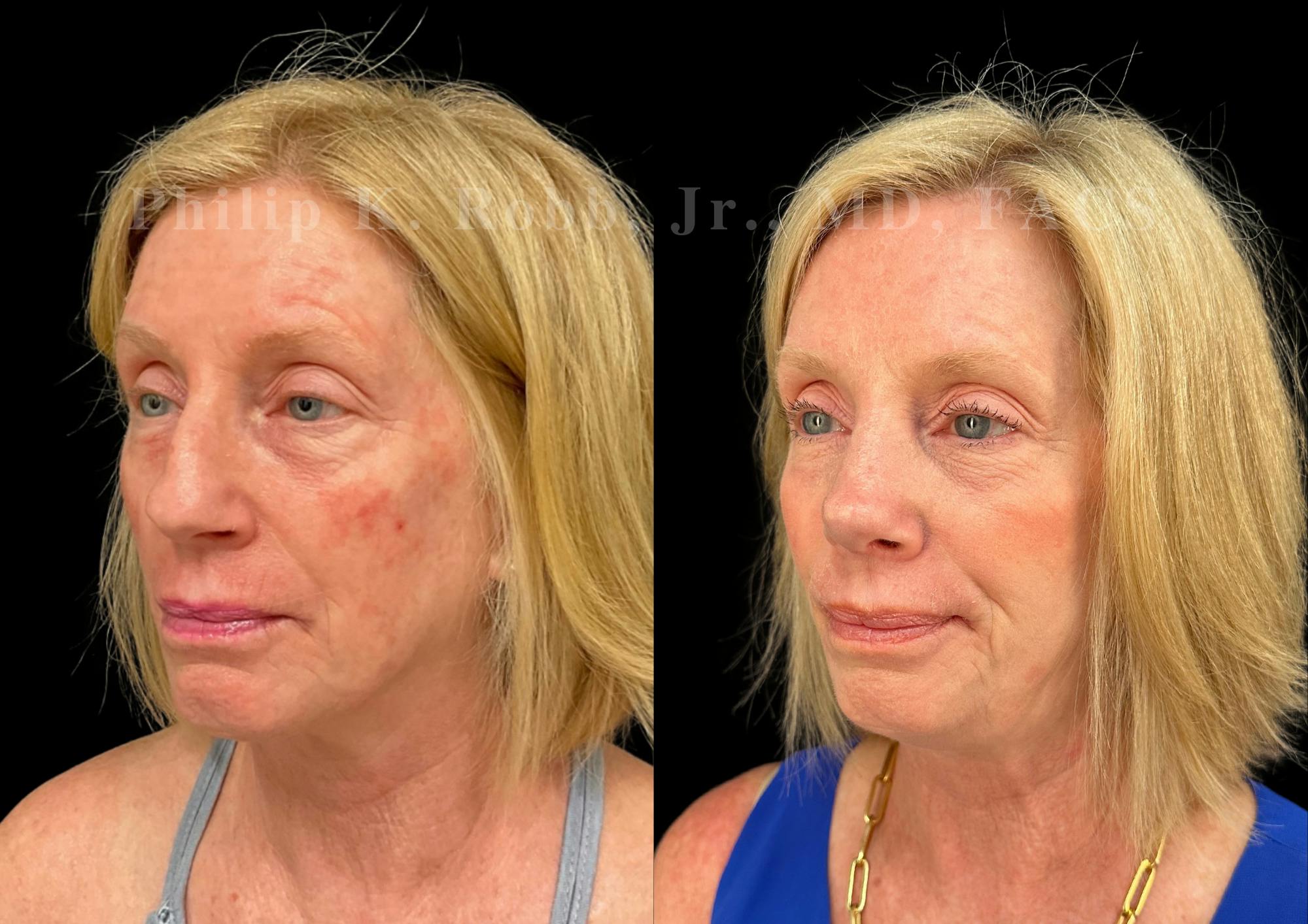 Ultrasonic Rhinoplasty Before & After Gallery - Patient 222735 - Image 4