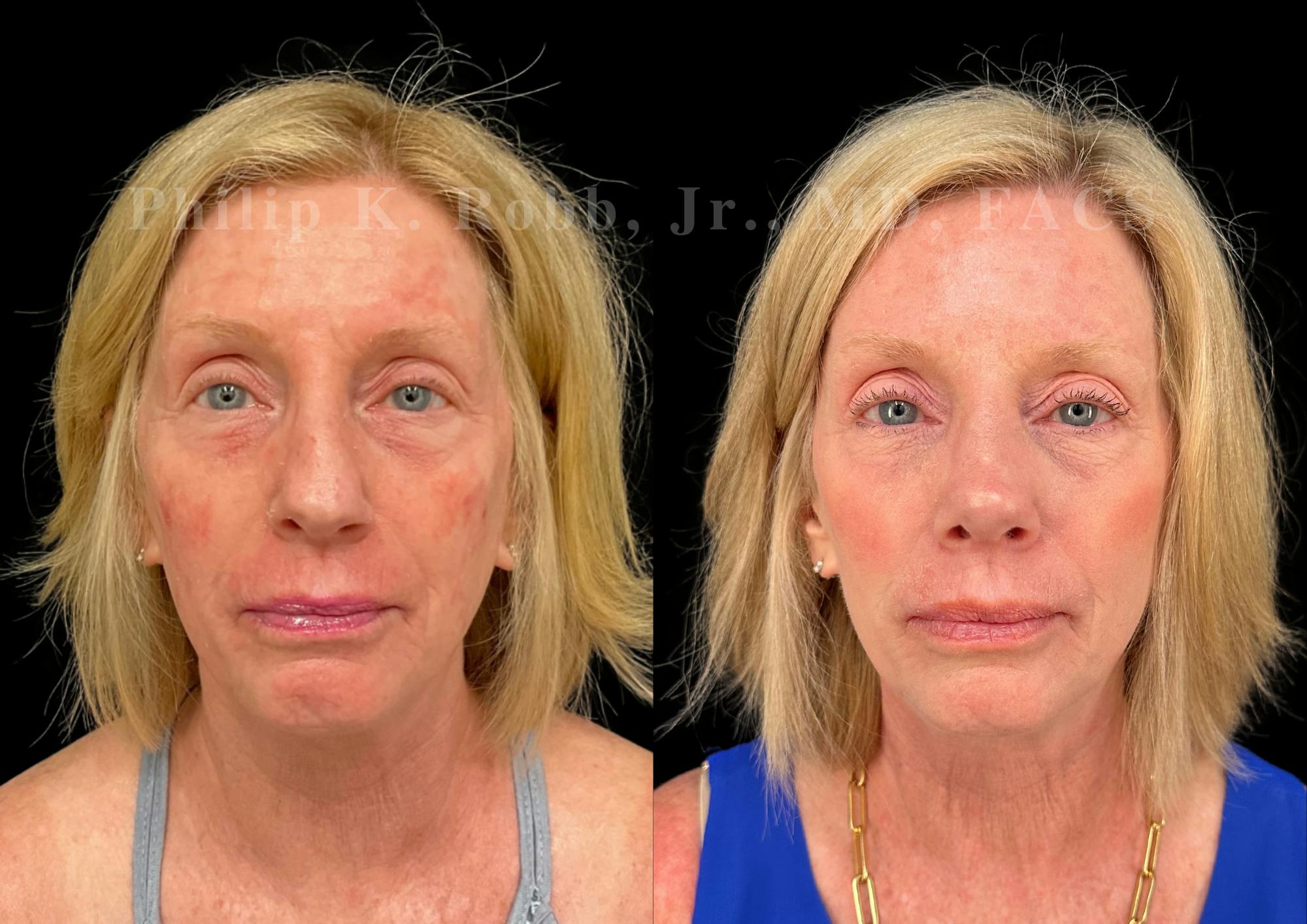 Ultrasonic Rhinoplasty Before & After Gallery - Patient 222735 - Image 3