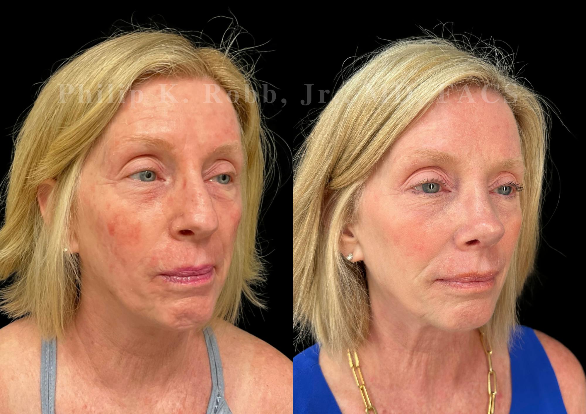 Ultrasonic Rhinoplasty Before & After Gallery - Patient 222735 - Image 2
