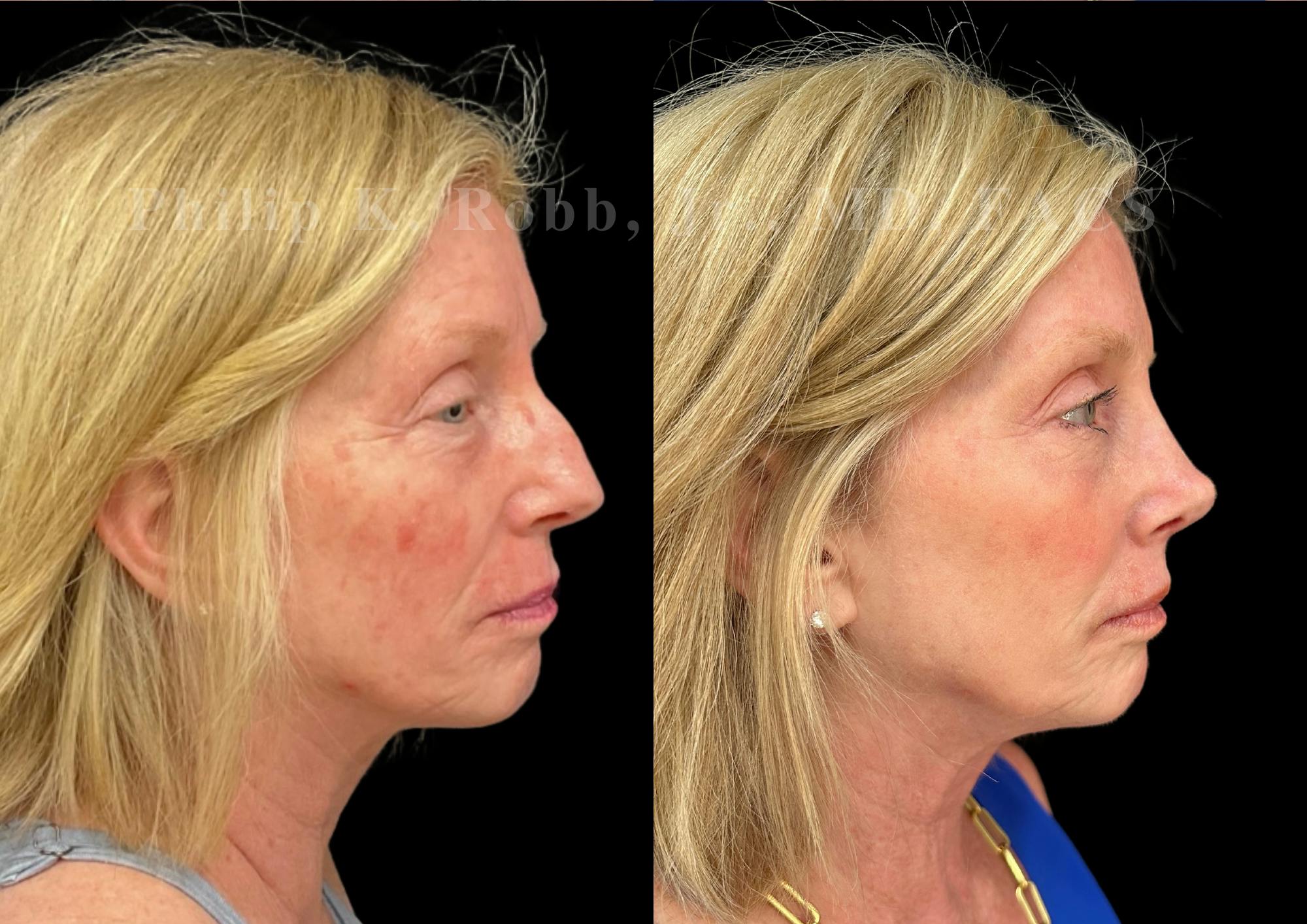Ultrasonic Rhinoplasty Before & After Gallery - Patient 222735 - Image 1