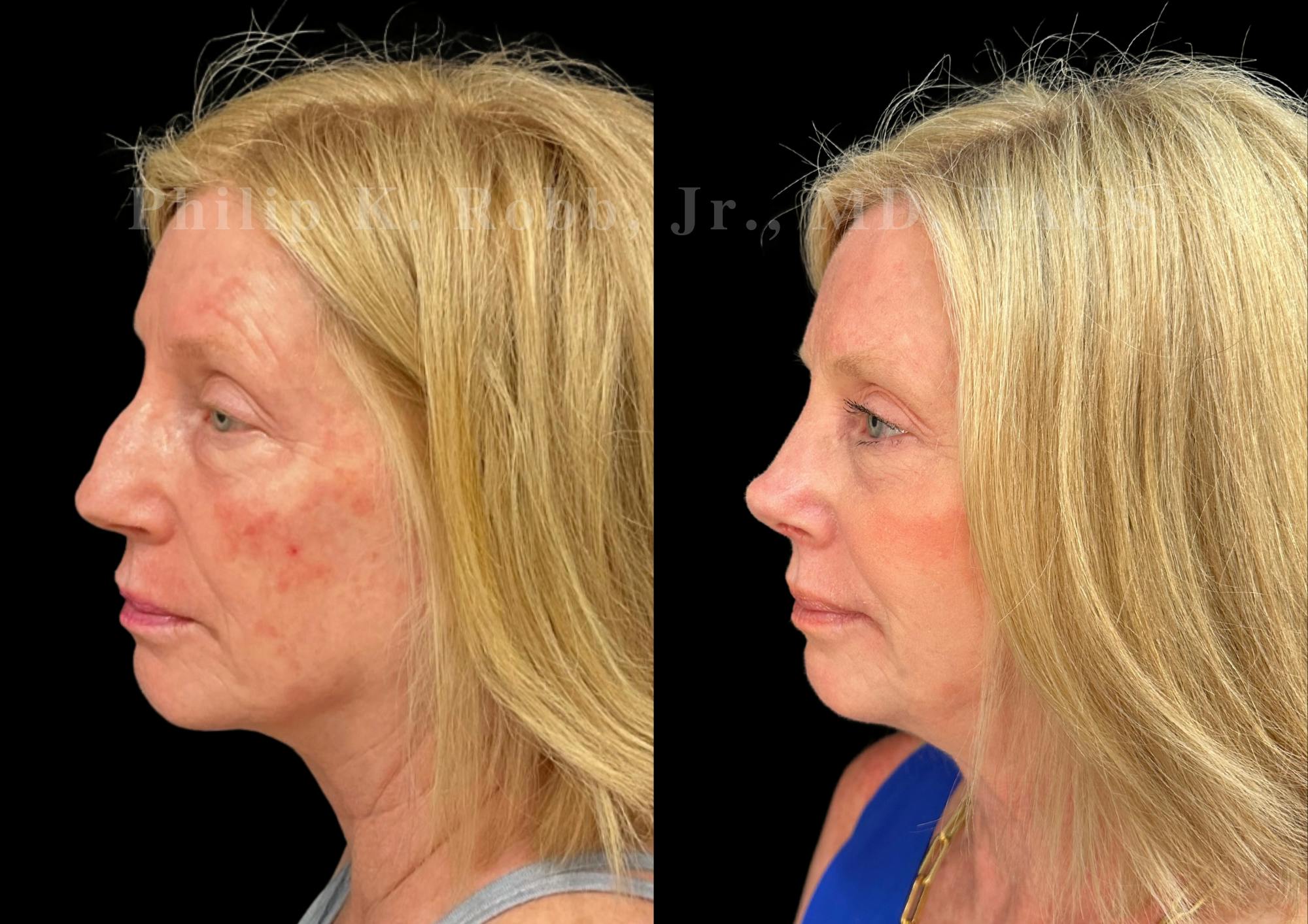 Ultrasonic Rhinoplasty Before & After Gallery - Patient 222735 - Image 5