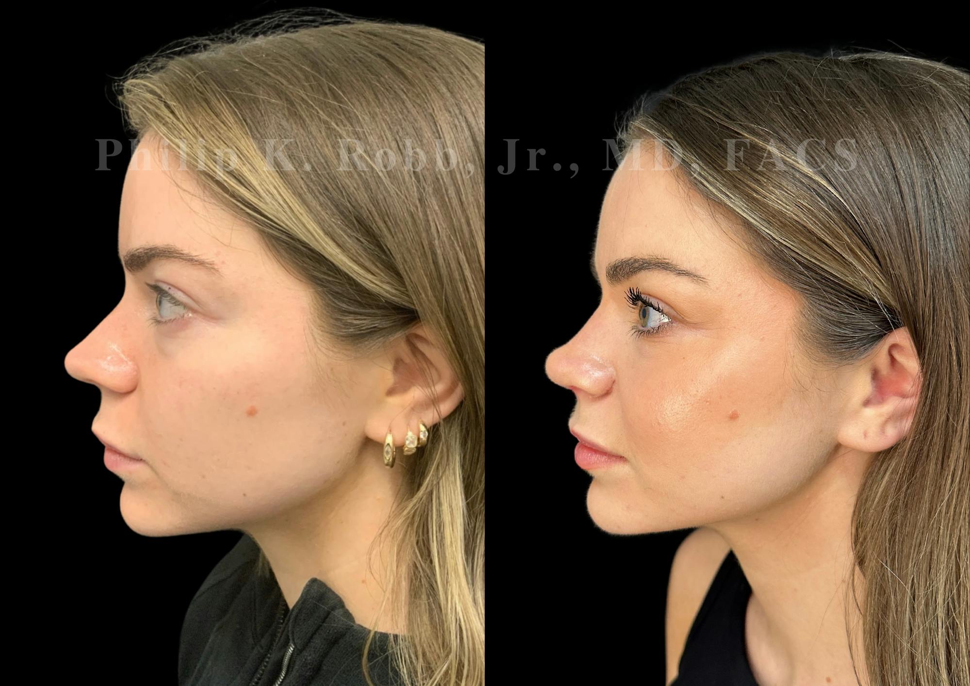 Ultrasonic Rhinoplasty Before & After Gallery - Patient 264660 - Image 5