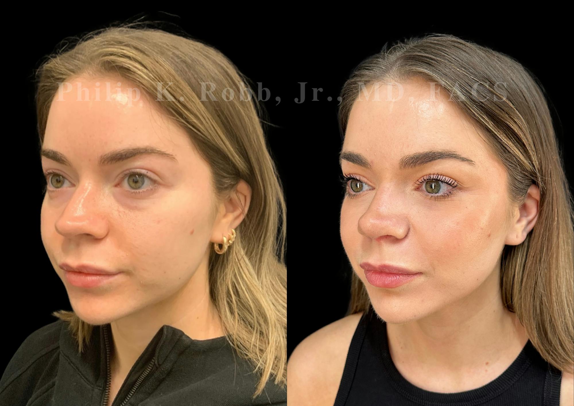 Ultrasonic Rhinoplasty Before & After Gallery - Patient 264660 - Image 4