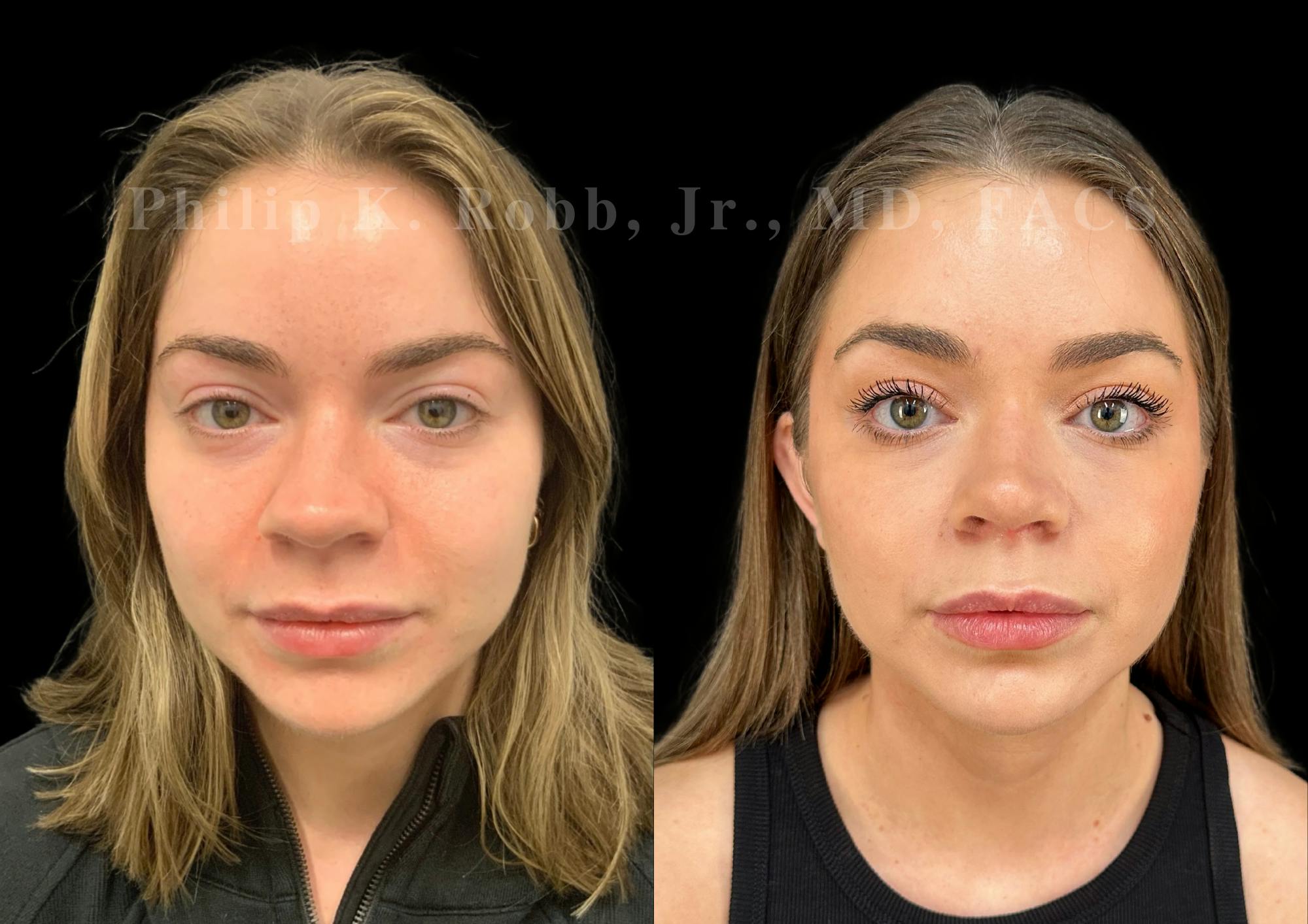 Ultrasonic Rhinoplasty Before & After Gallery - Patient 264660 - Image 3