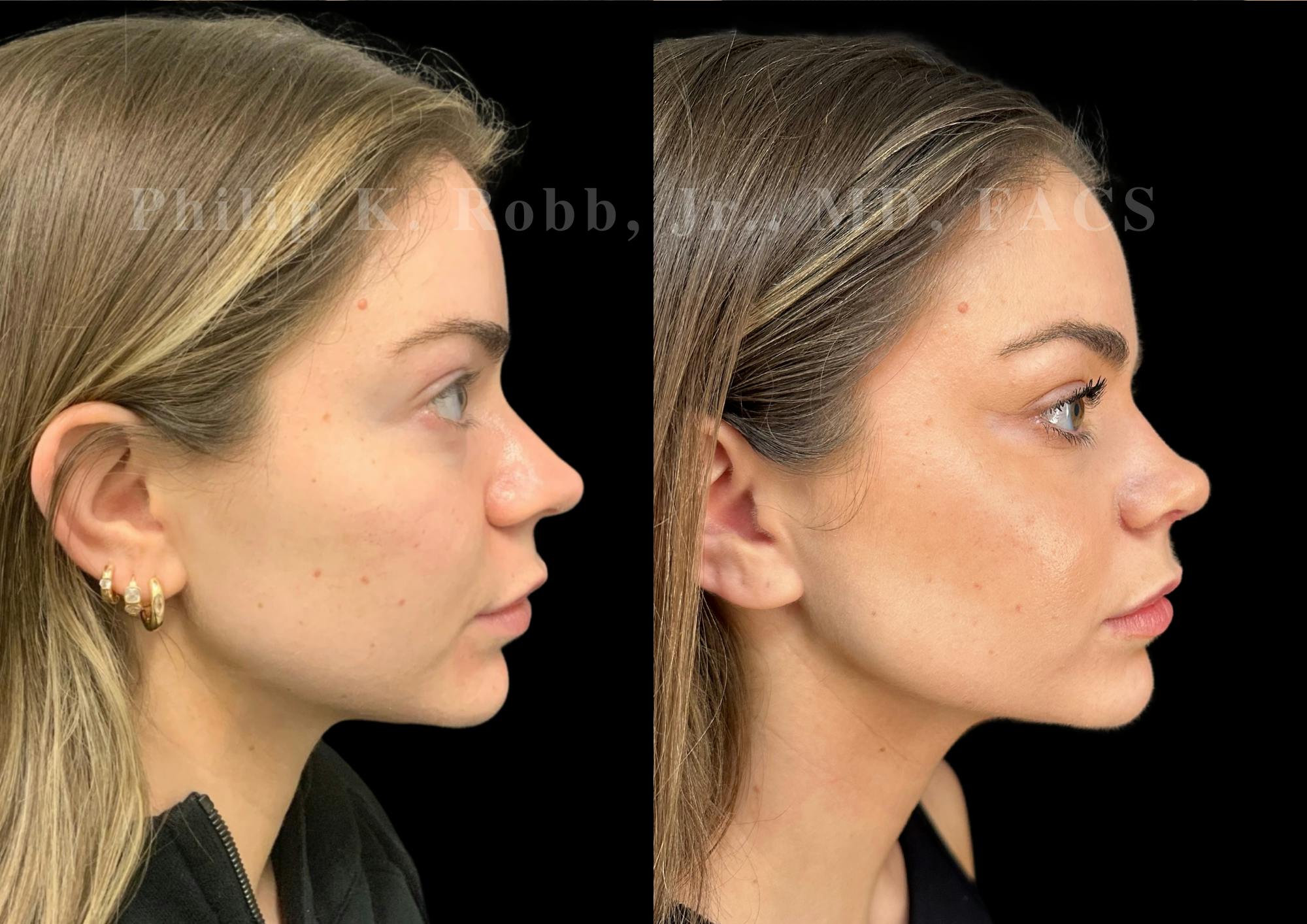 Ultrasonic Rhinoplasty Before & After Gallery - Patient 264660 - Image 1