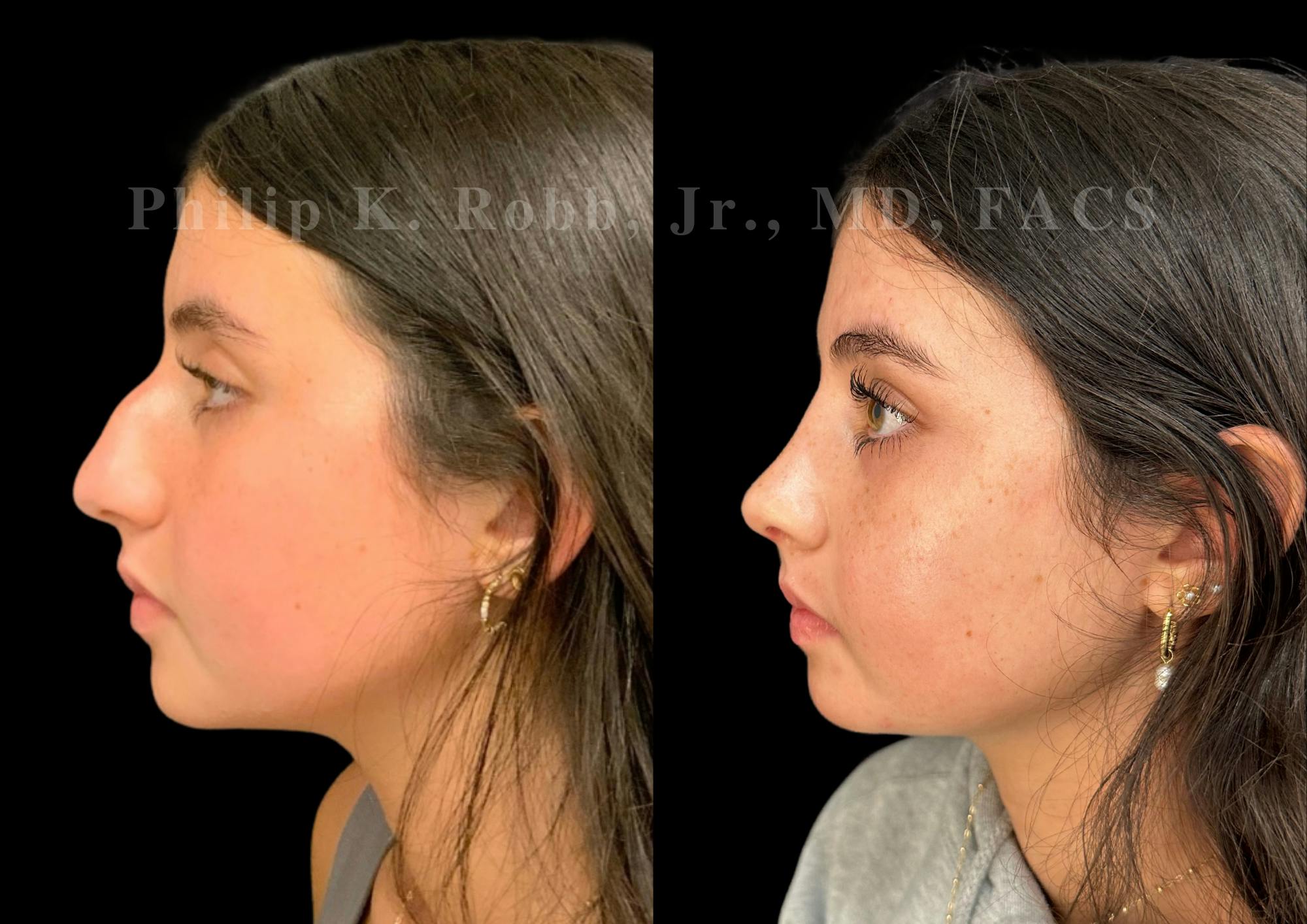 Ultrasonic Rhinoplasty Before & After Gallery - Patient 119916 - Image 5