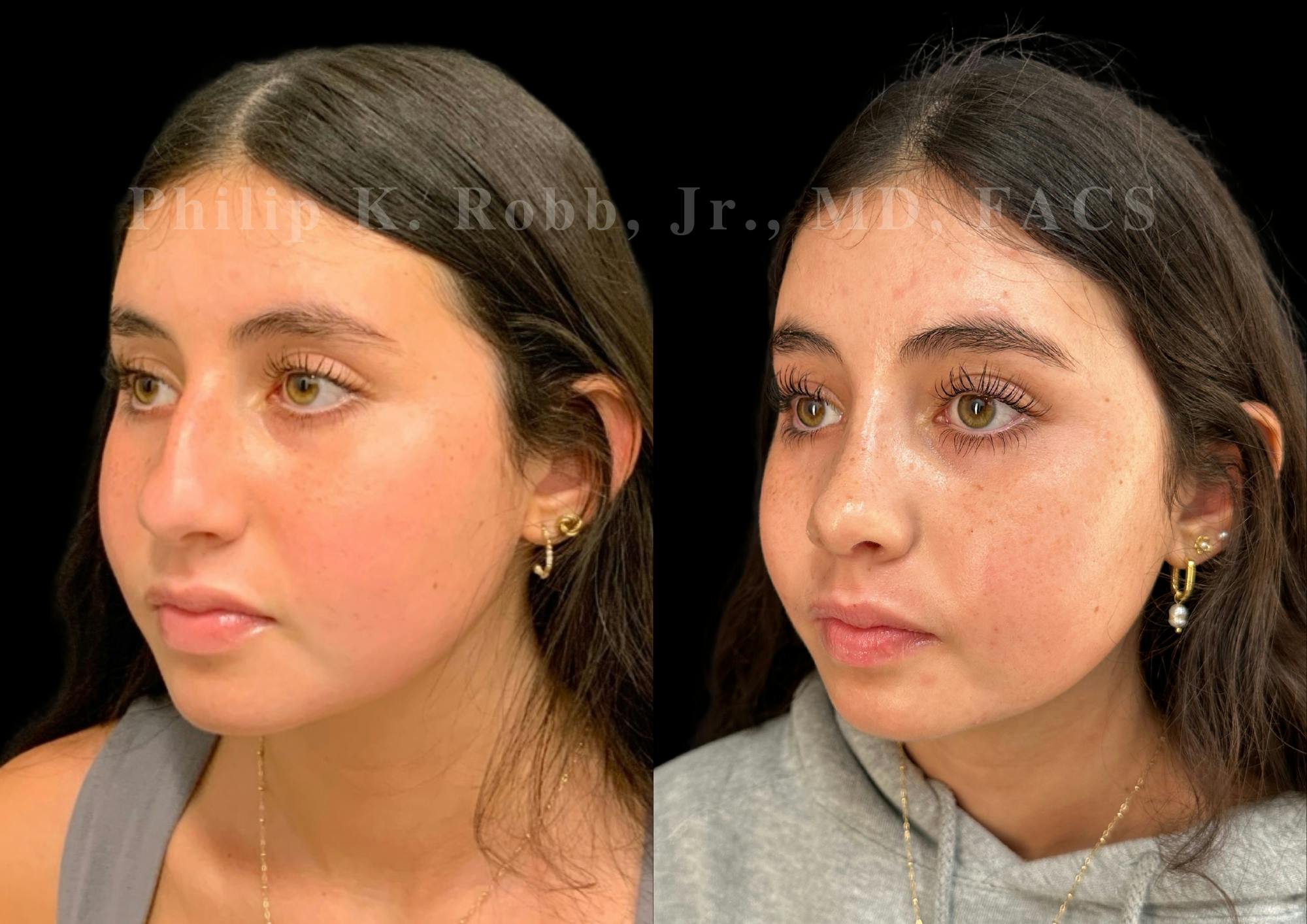 Ultrasonic Rhinoplasty Before & After Gallery - Patient 119916 - Image 4