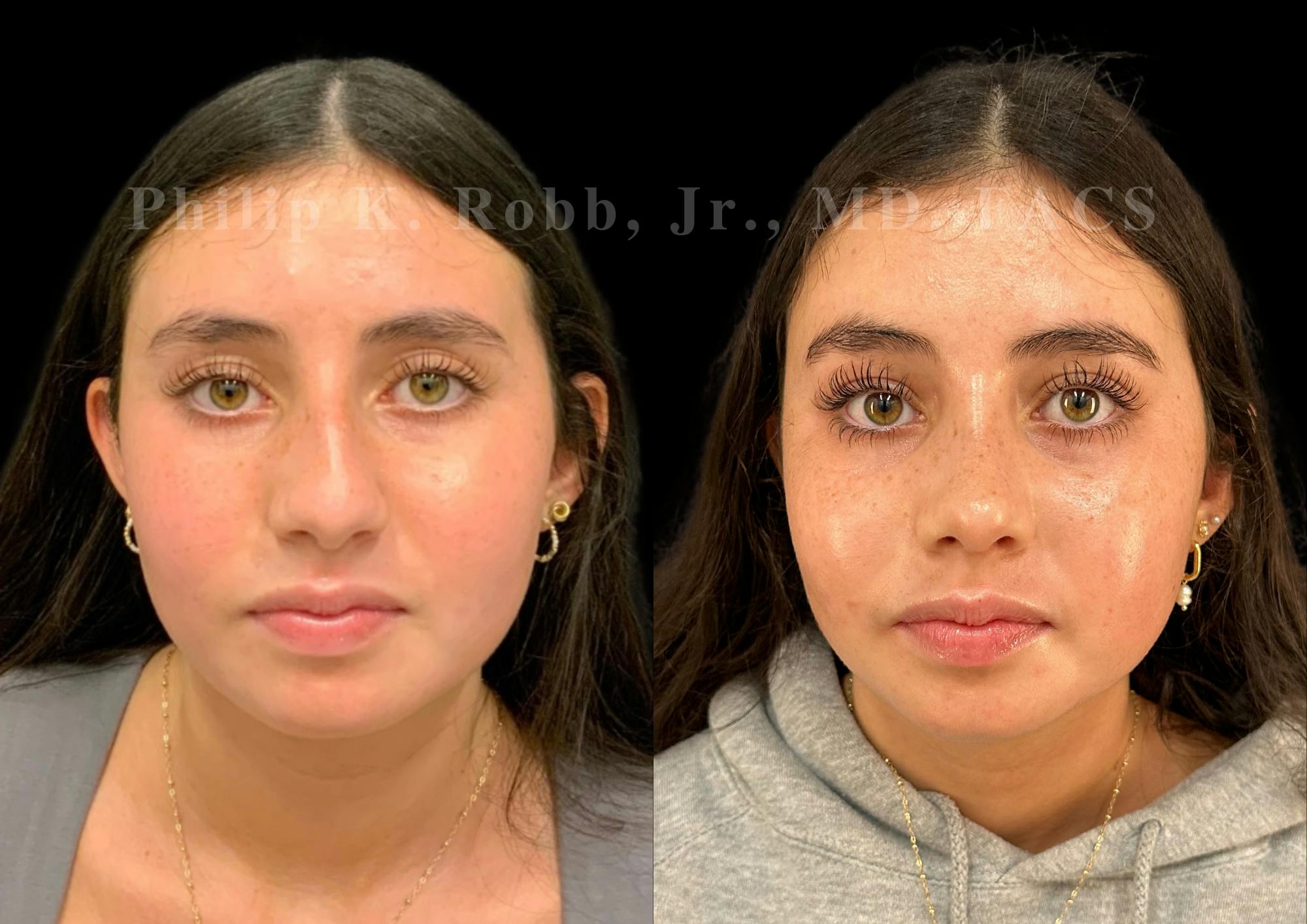 Ultrasonic Rhinoplasty Before & After Gallery - Patient 119916 - Image 3