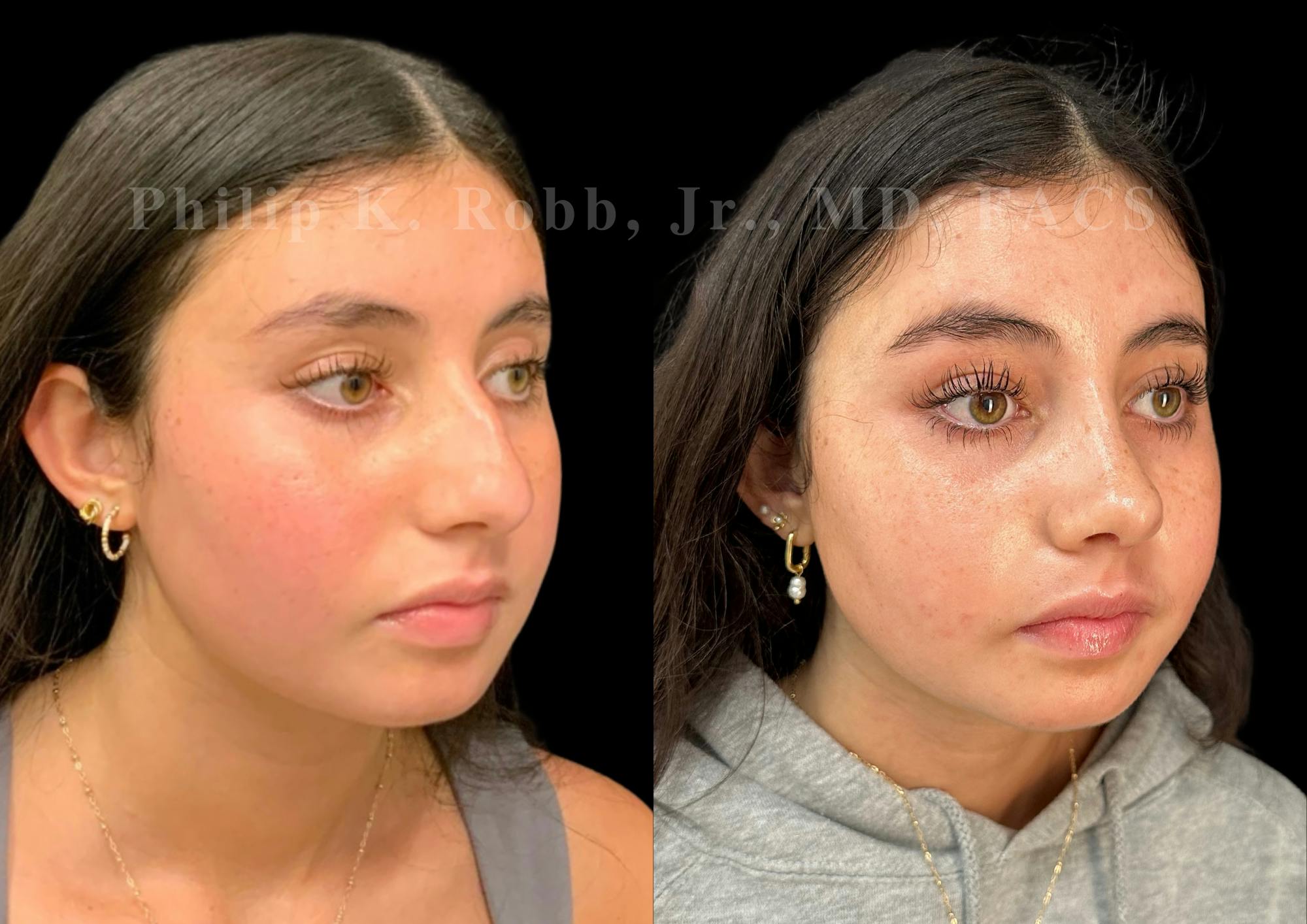 Ultrasonic Rhinoplasty Before & After Gallery - Patient 119916 - Image 2