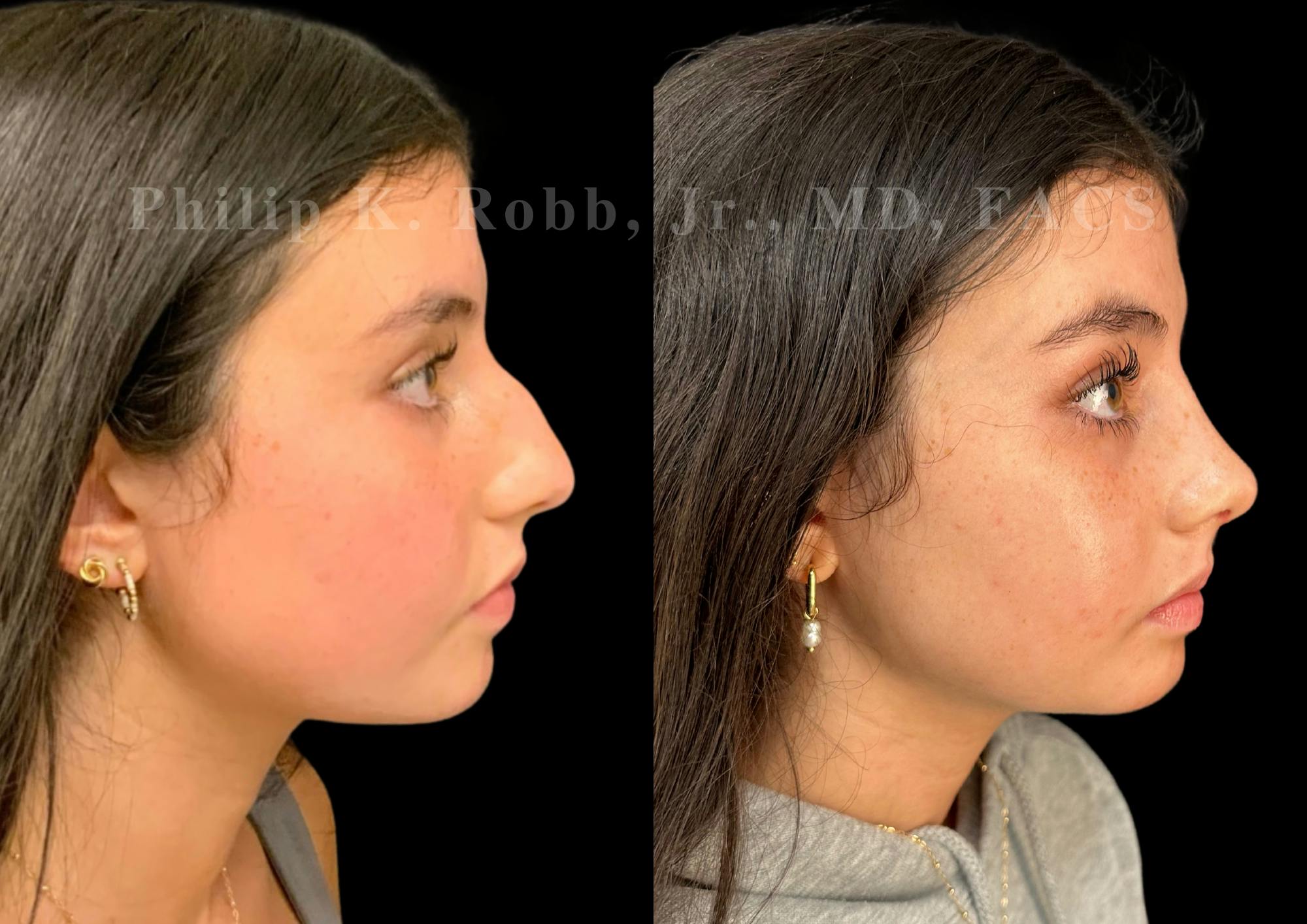Ultrasonic Rhinoplasty Before & After Gallery - Patient 119916 - Image 1