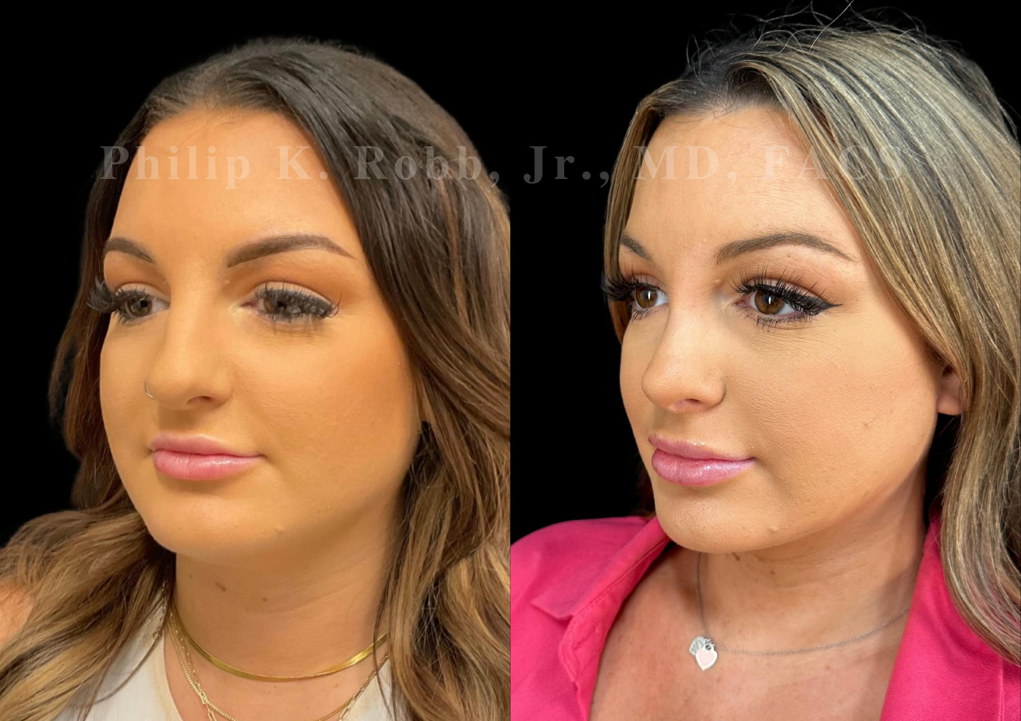 Ultrasonic Rhinoplasty Before & After Gallery - Patient 411900 - Image 4