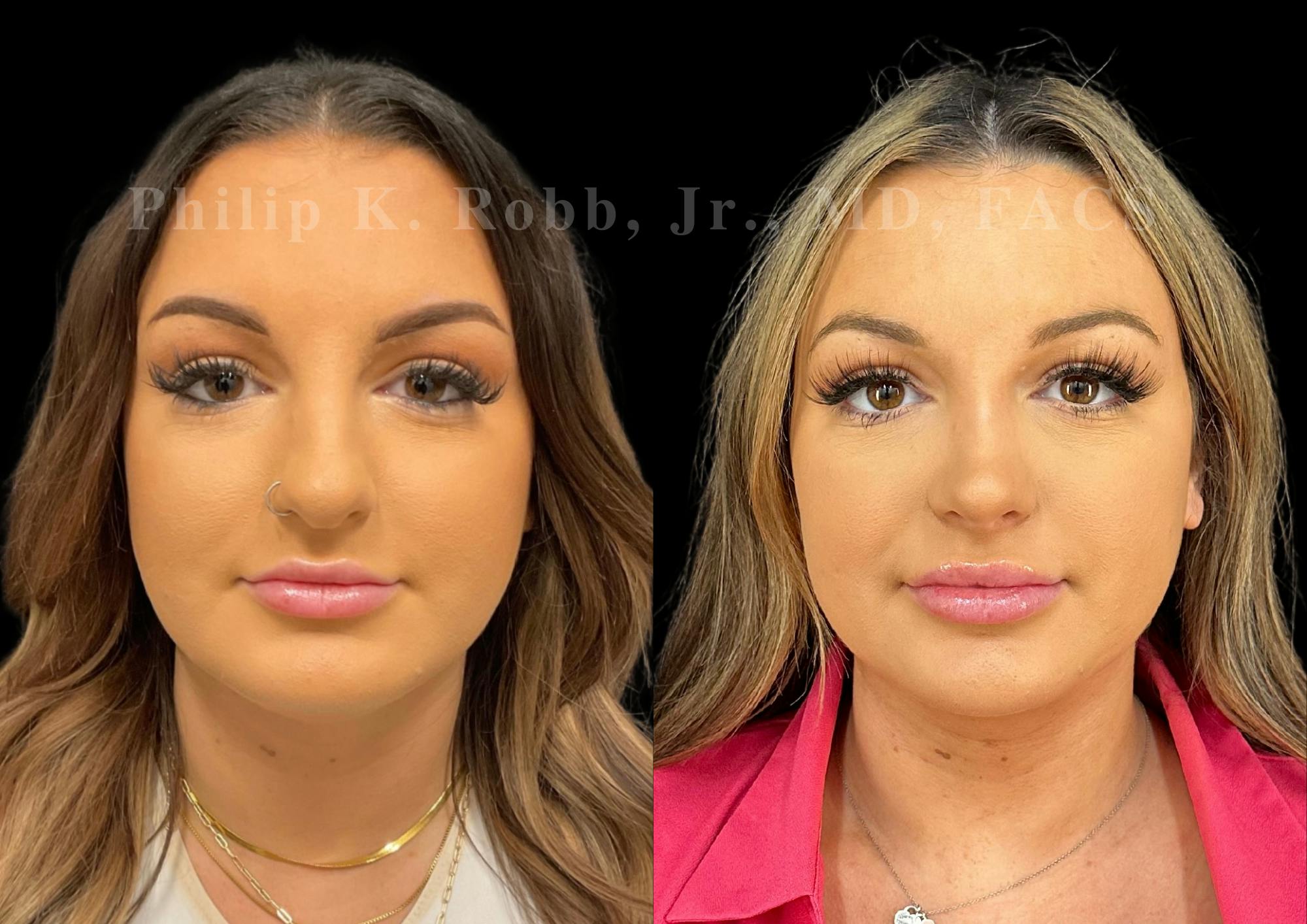 Ultrasonic Rhinoplasty Before & After Gallery - Patient 411900 - Image 3