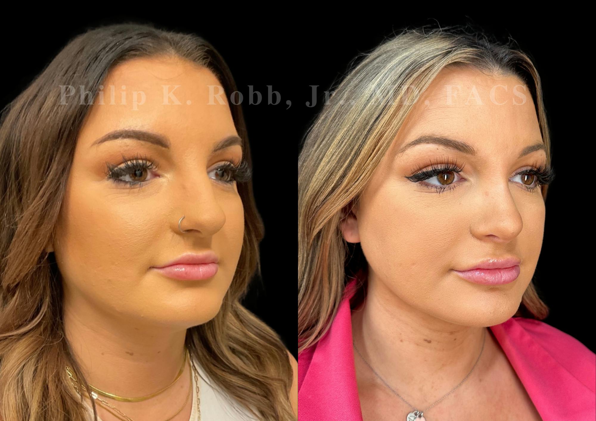 Ultrasonic Rhinoplasty Before & After Gallery - Patient 411900 - Image 2