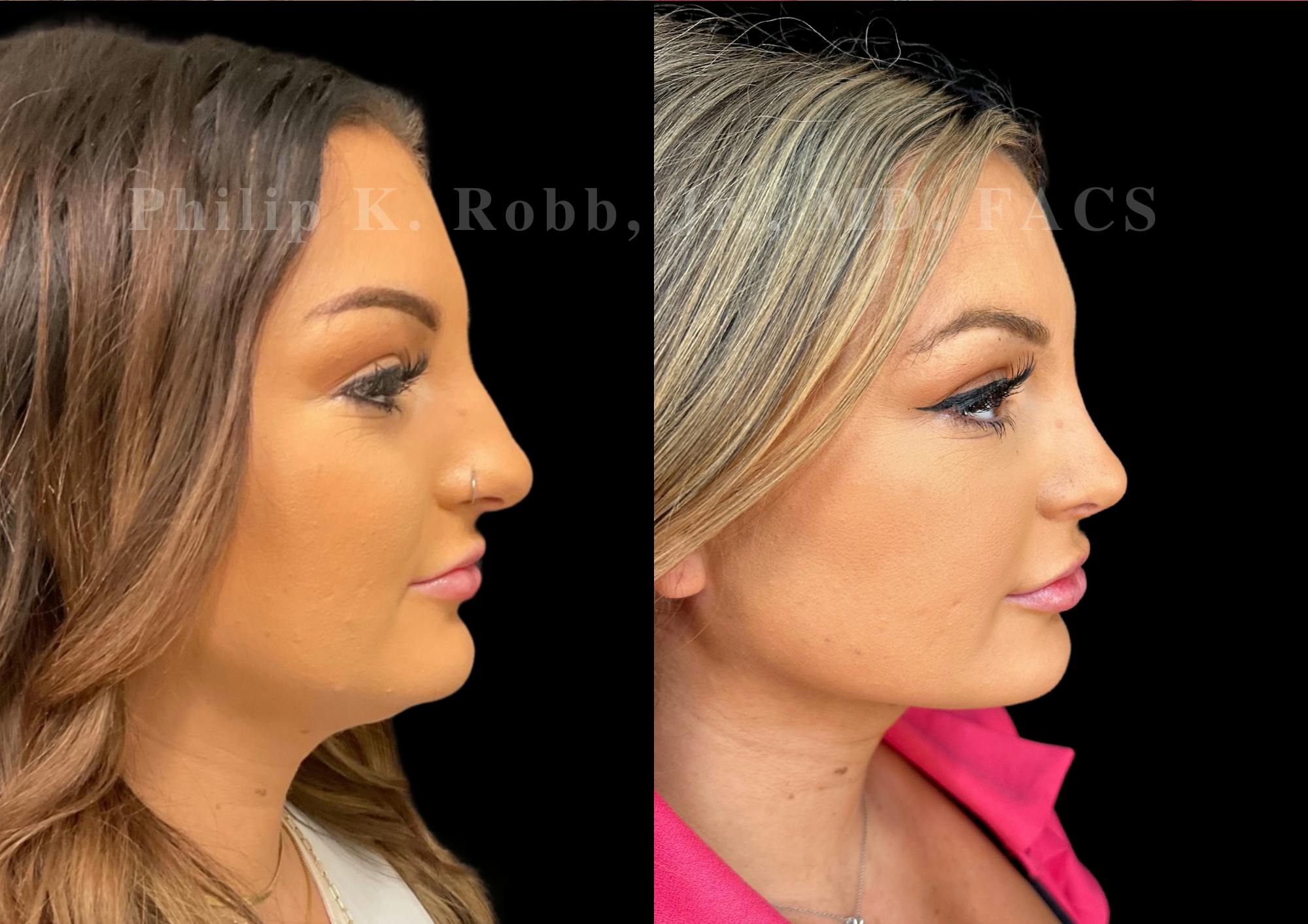Ultrasonic Rhinoplasty Before & After Gallery - Patient 411900 - Image 1