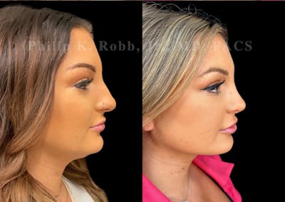 Ultrasonic Rhinoplasty Before & After Gallery - Patient 411900 - Image 1