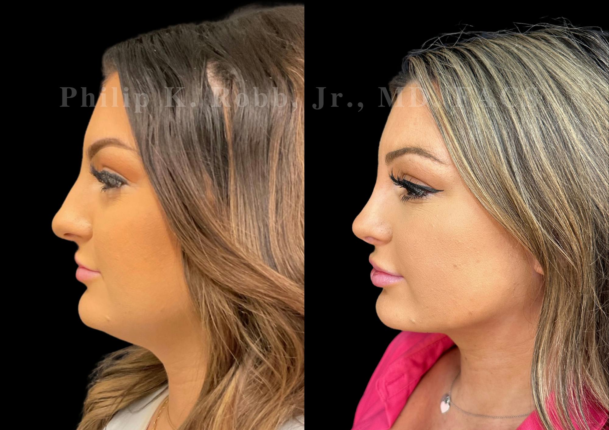 Ultrasonic Rhinoplasty Before & After Gallery - Patient 411900 - Image 5