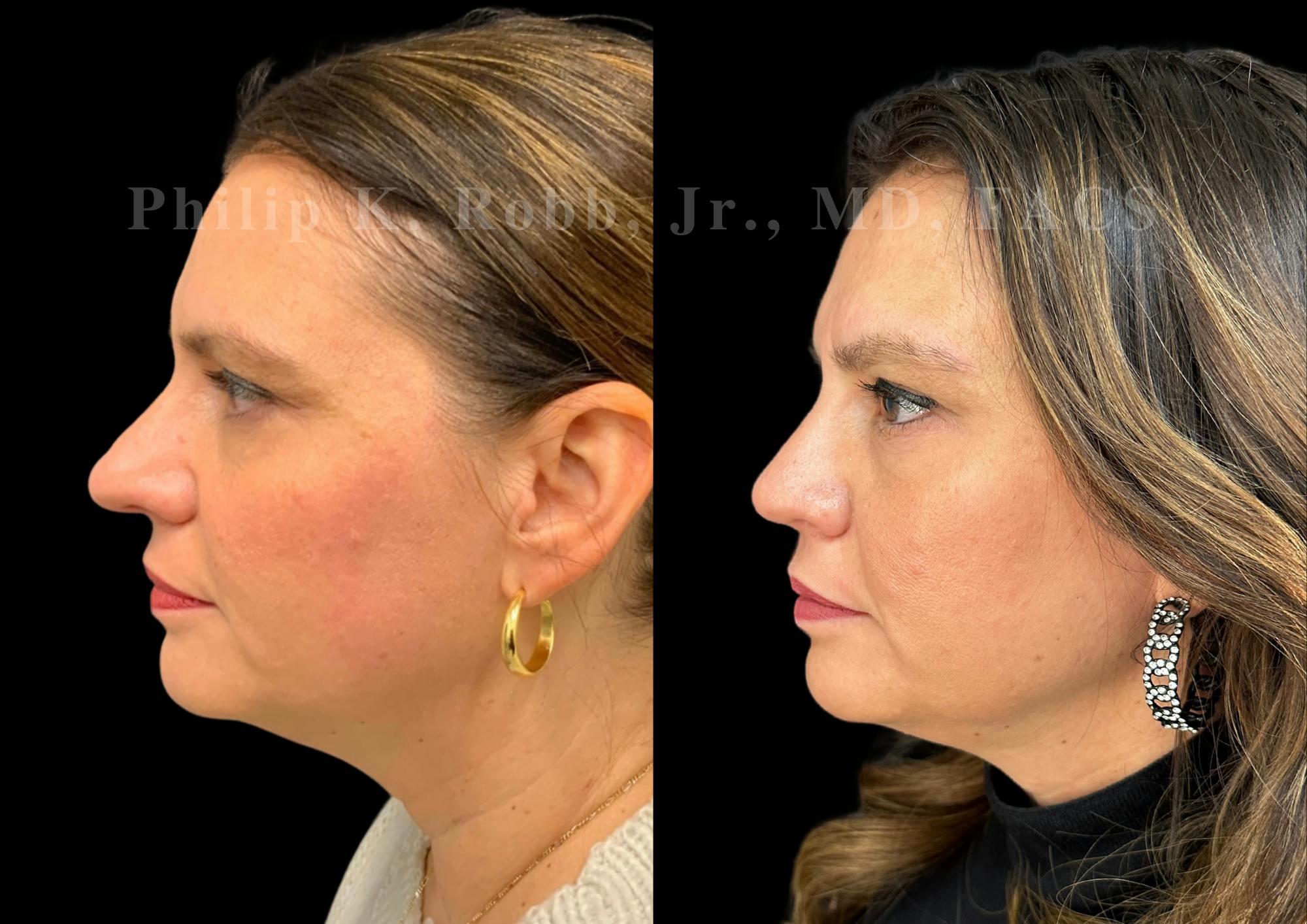 Ultrasonic Rhinoplasty Before & After Gallery - Patient 168602 - Image 5
