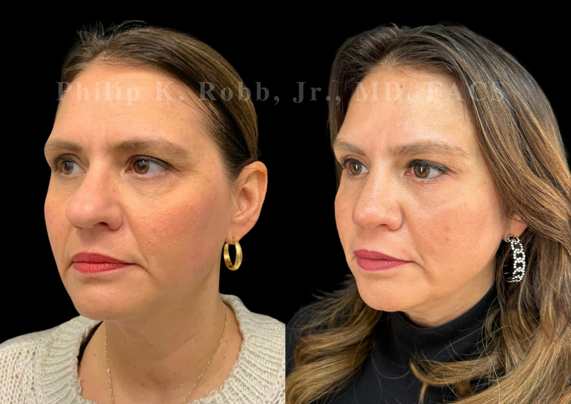 Ultrasonic Rhinoplasty Before & After Gallery - Patient 168602 - Image 4