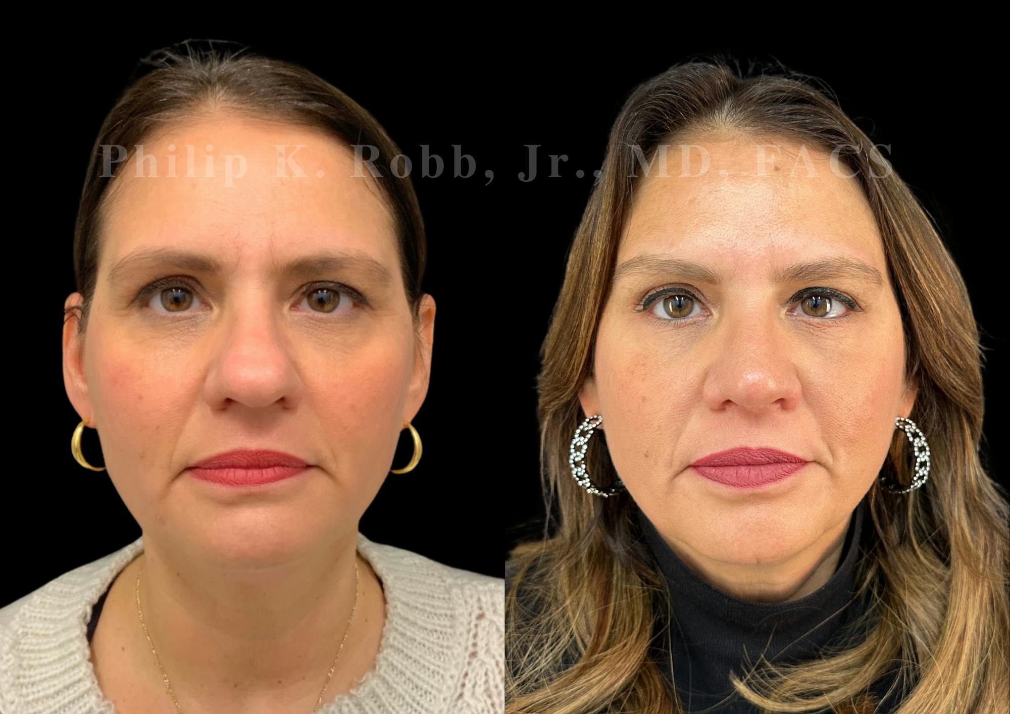 Ultrasonic Rhinoplasty Before & After Gallery - Patient 168602 - Image 3