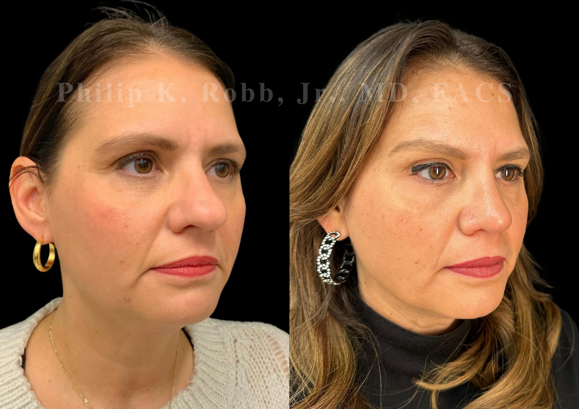 Ultrasonic Rhinoplasty Before & After Gallery - Patient 168602 - Image 2