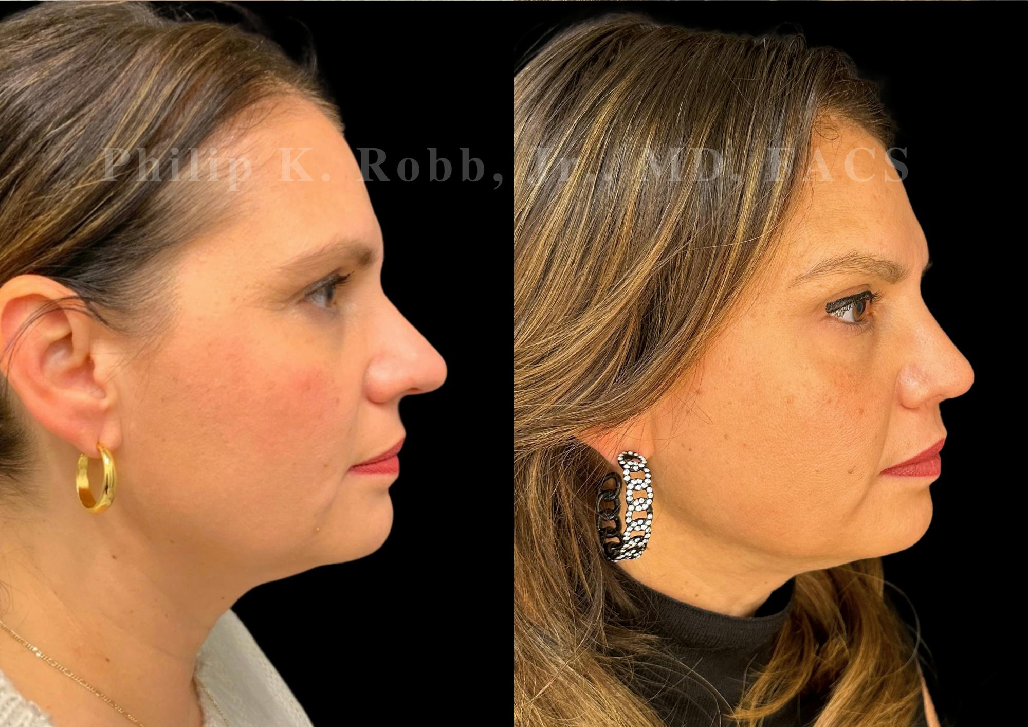 Ultrasonic Rhinoplasty Before & After Gallery - Patient 168602 - Image 1