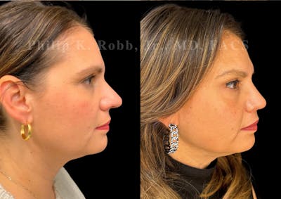 Ultrasonic Rhinoplasty Before & After Gallery - Patient 168602 - Image 1