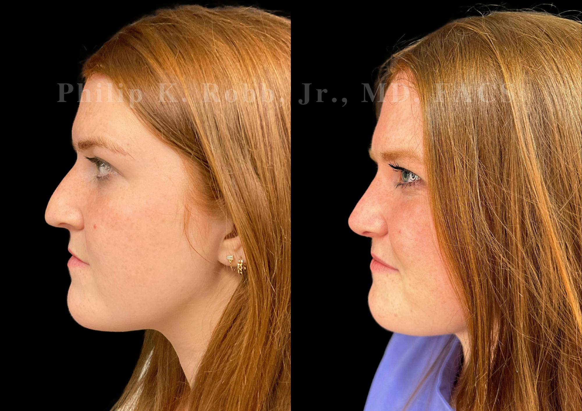 Ultrasonic Rhinoplasty Before & After Gallery - Patient 586859 - Image 5