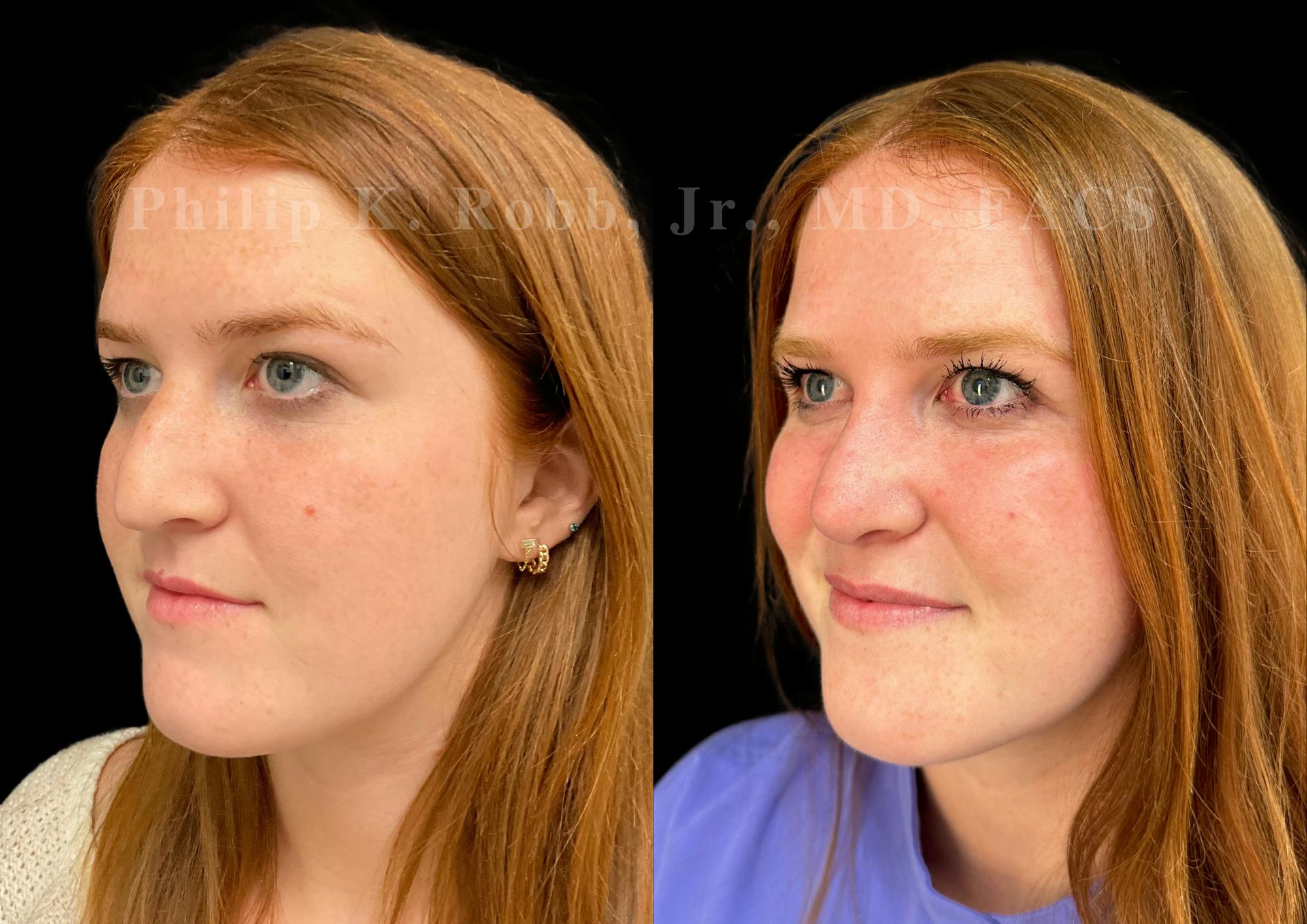 Ultrasonic Rhinoplasty Before & After Gallery - Patient 586859 - Image 4