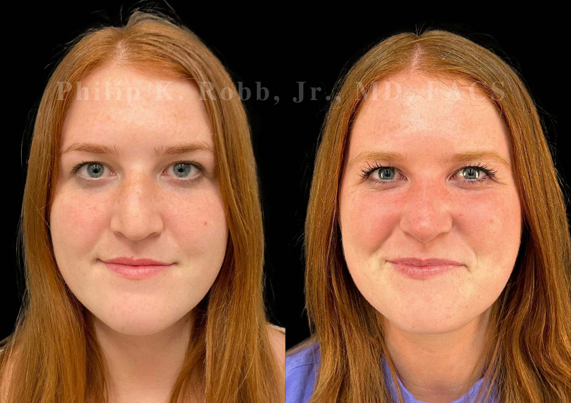 Ultrasonic Rhinoplasty Before & After Gallery - Patient 586859 - Image 3