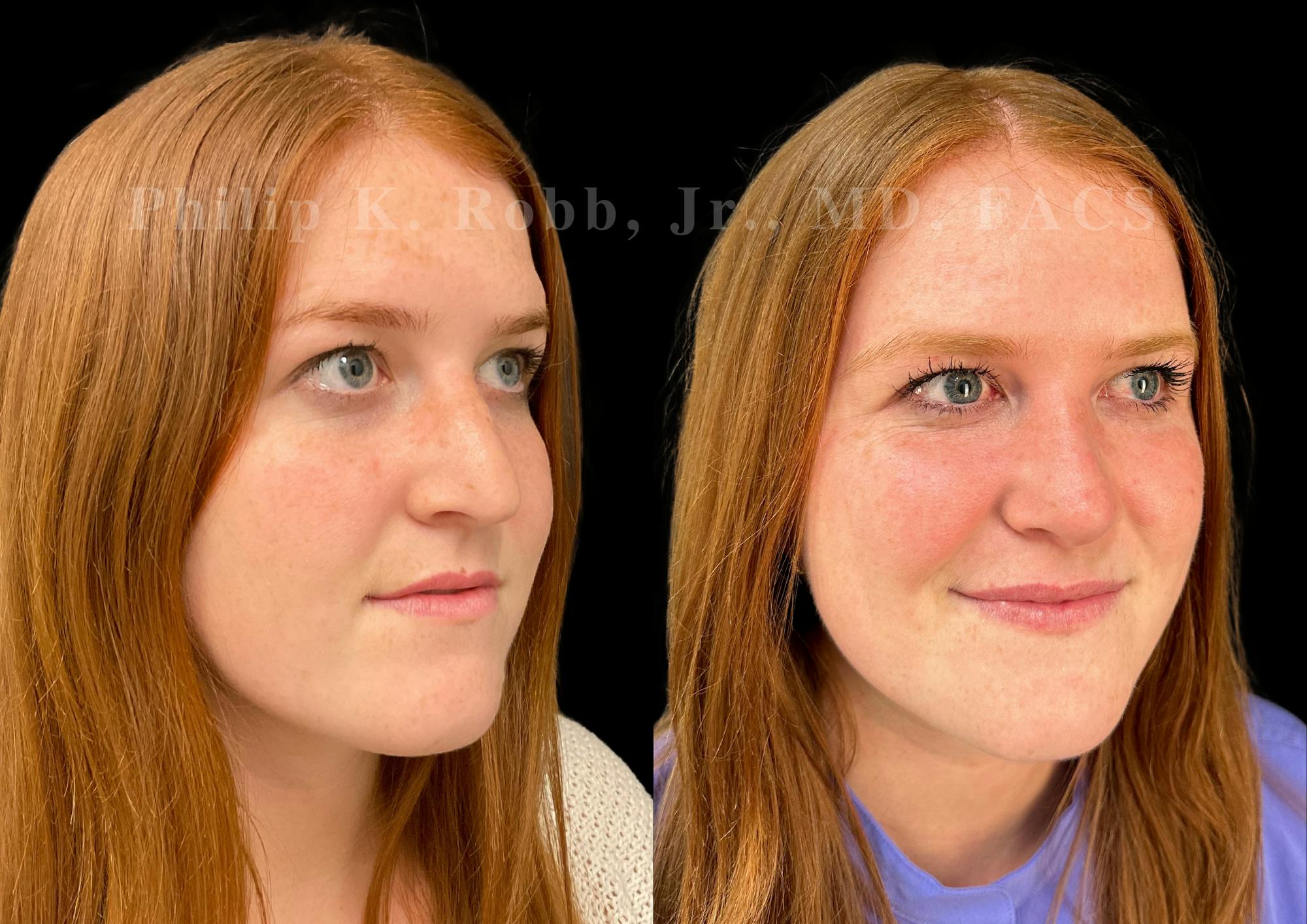 Ultrasonic Rhinoplasty Before & After Gallery - Patient 586859 - Image 2