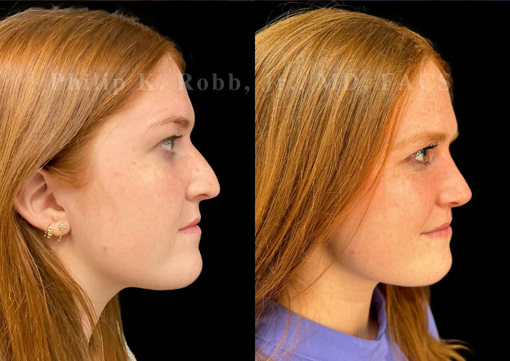 Ultrasonic Rhinoplasty Before & After Gallery - Patient 586859 - Image 1