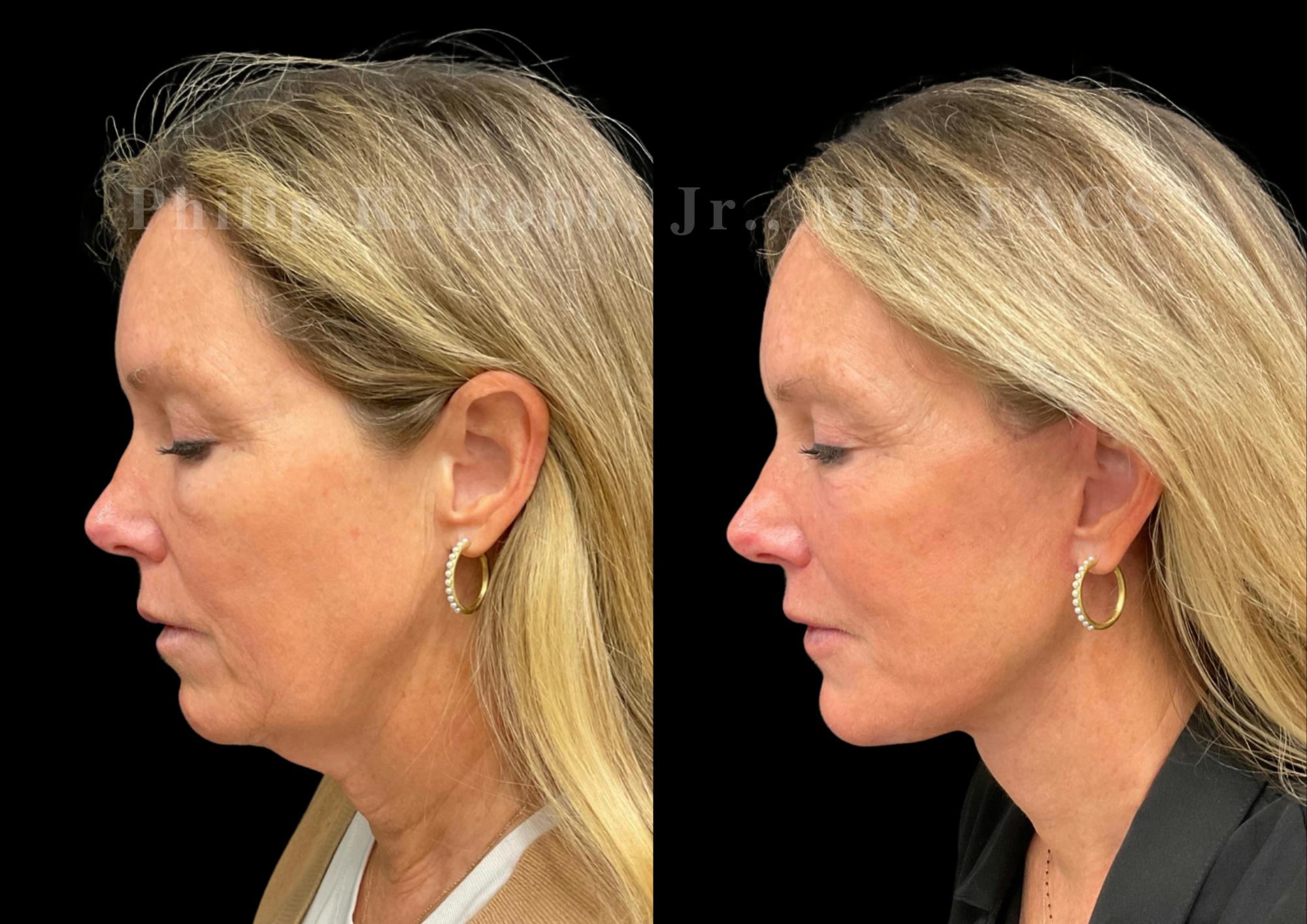 Brow Lift Before & After Gallery - Patient 397690 - Image 4
