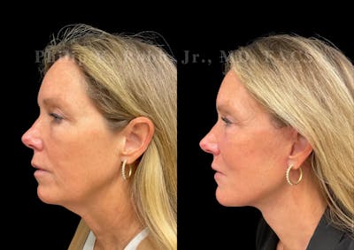 Neck Lift Before & After Gallery - Patient 292799 - Image 1