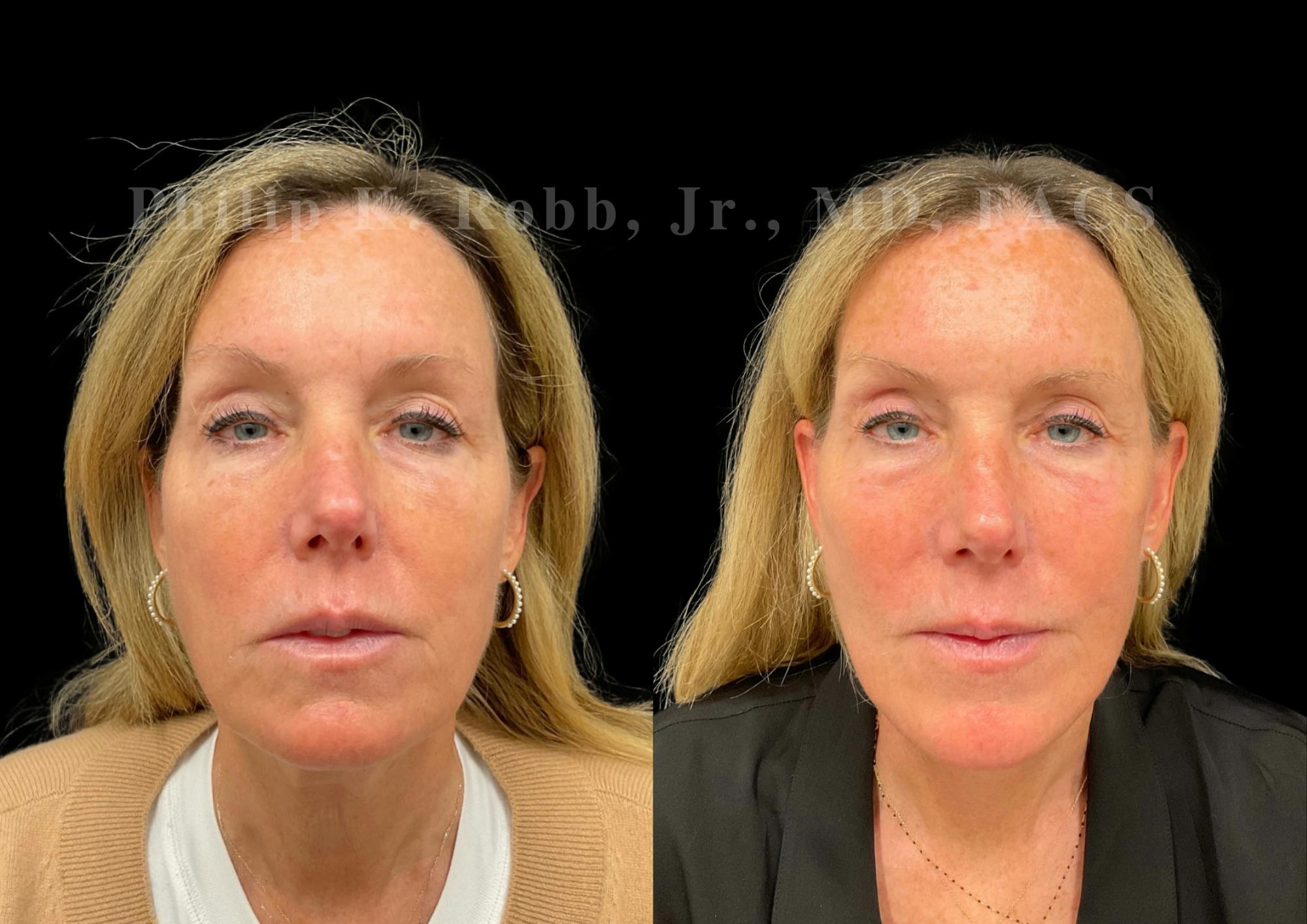 Brow Lift Before & After Gallery - Patient 397690 - Image 1