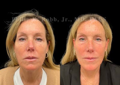 Brow Lift Before & After Gallery - Patient 397690 - Image 1
