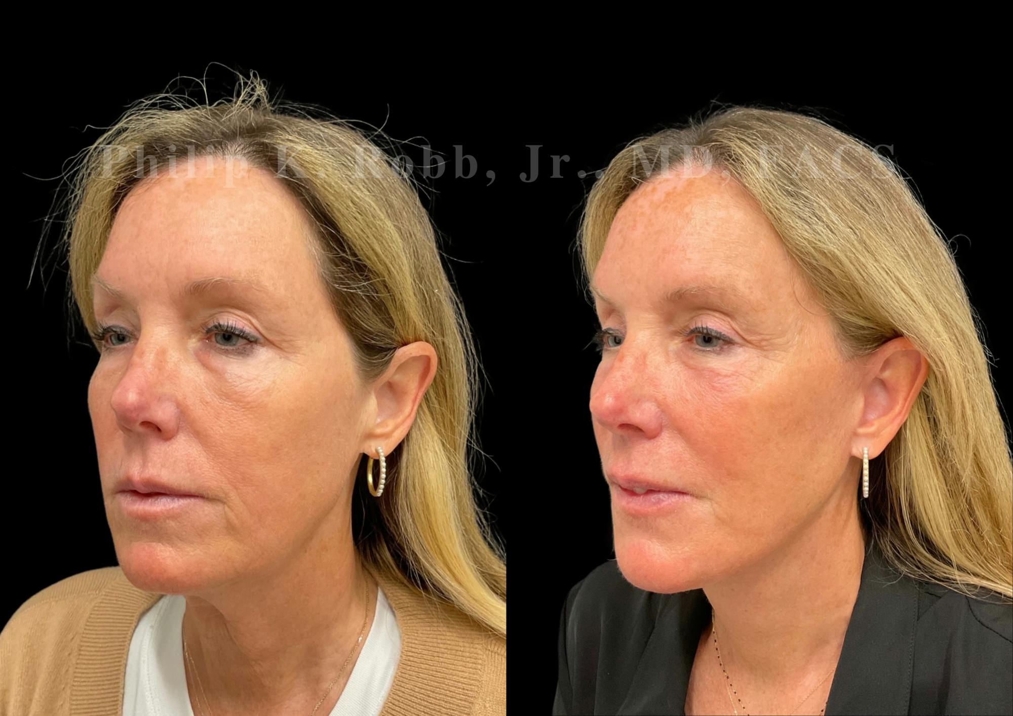 Brow Lift Before & After Gallery - Patient 397690 - Image 2
