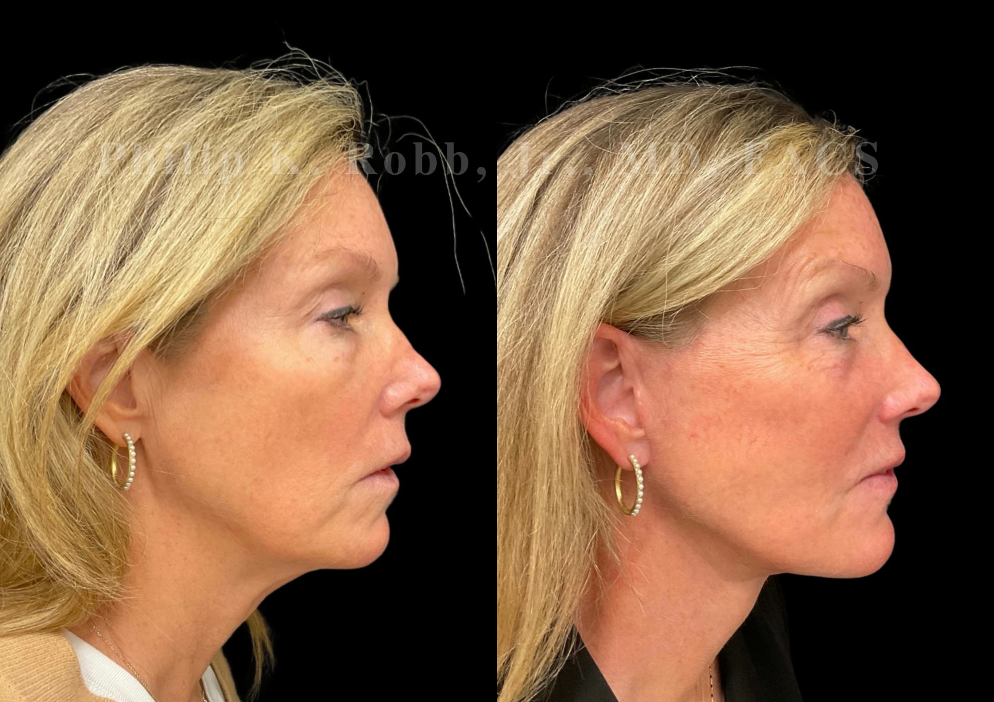 Brow Lift Before & After Gallery - Patient 397690 - Image 6